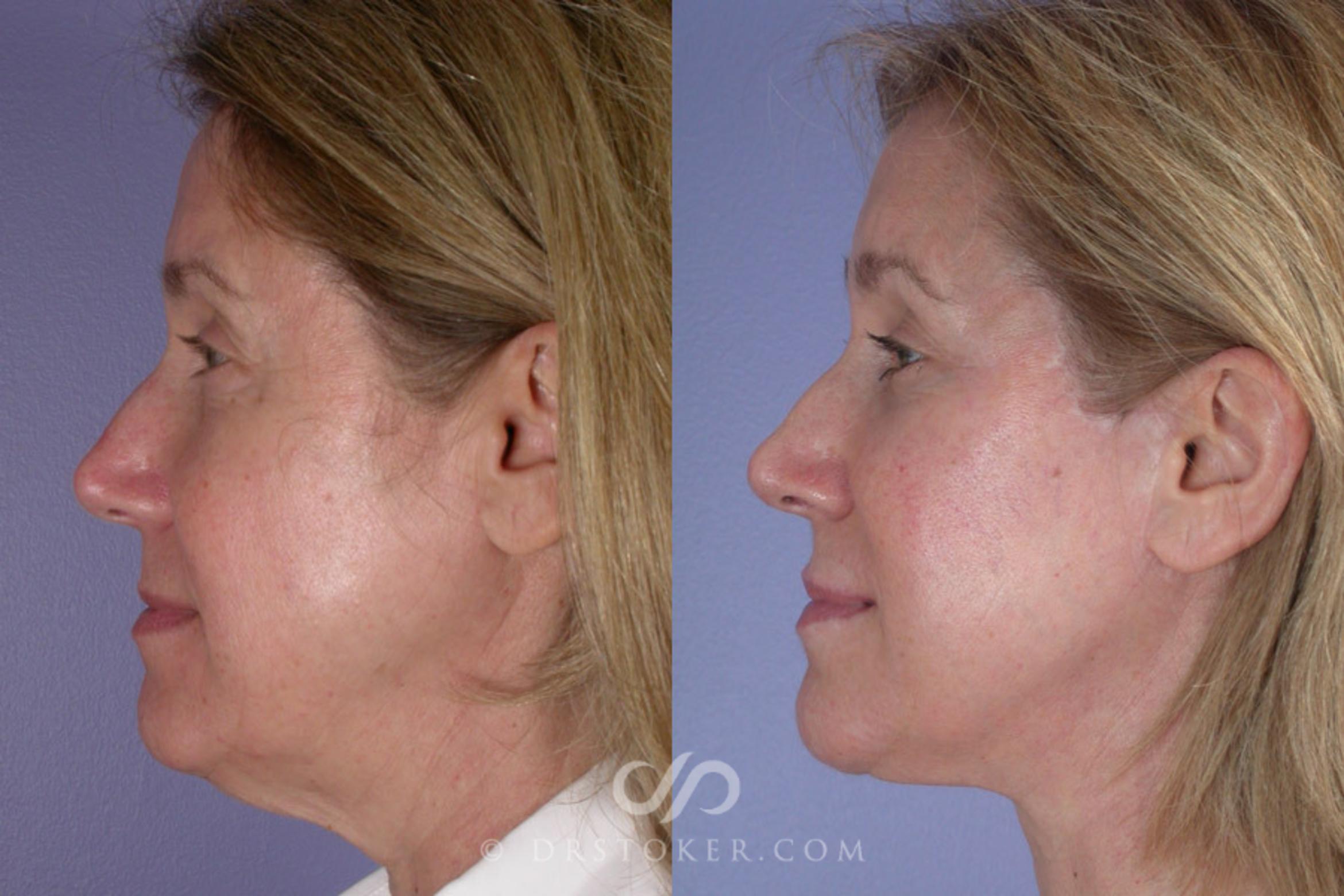 Before & After Facelift - Traceless Facelift Case 257 View #4 View in Los Angeles, CA