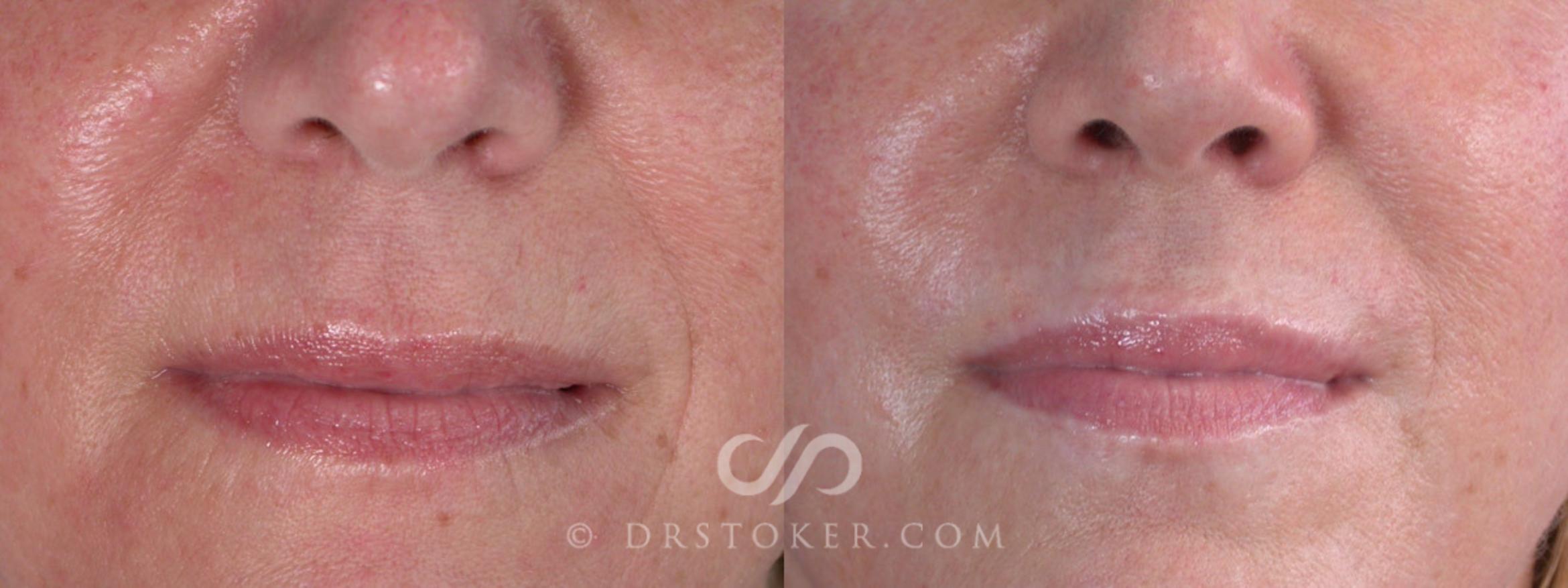 Before & After Facelift - Traceless Facelift Case 257 View #6 View in Los Angeles, CA