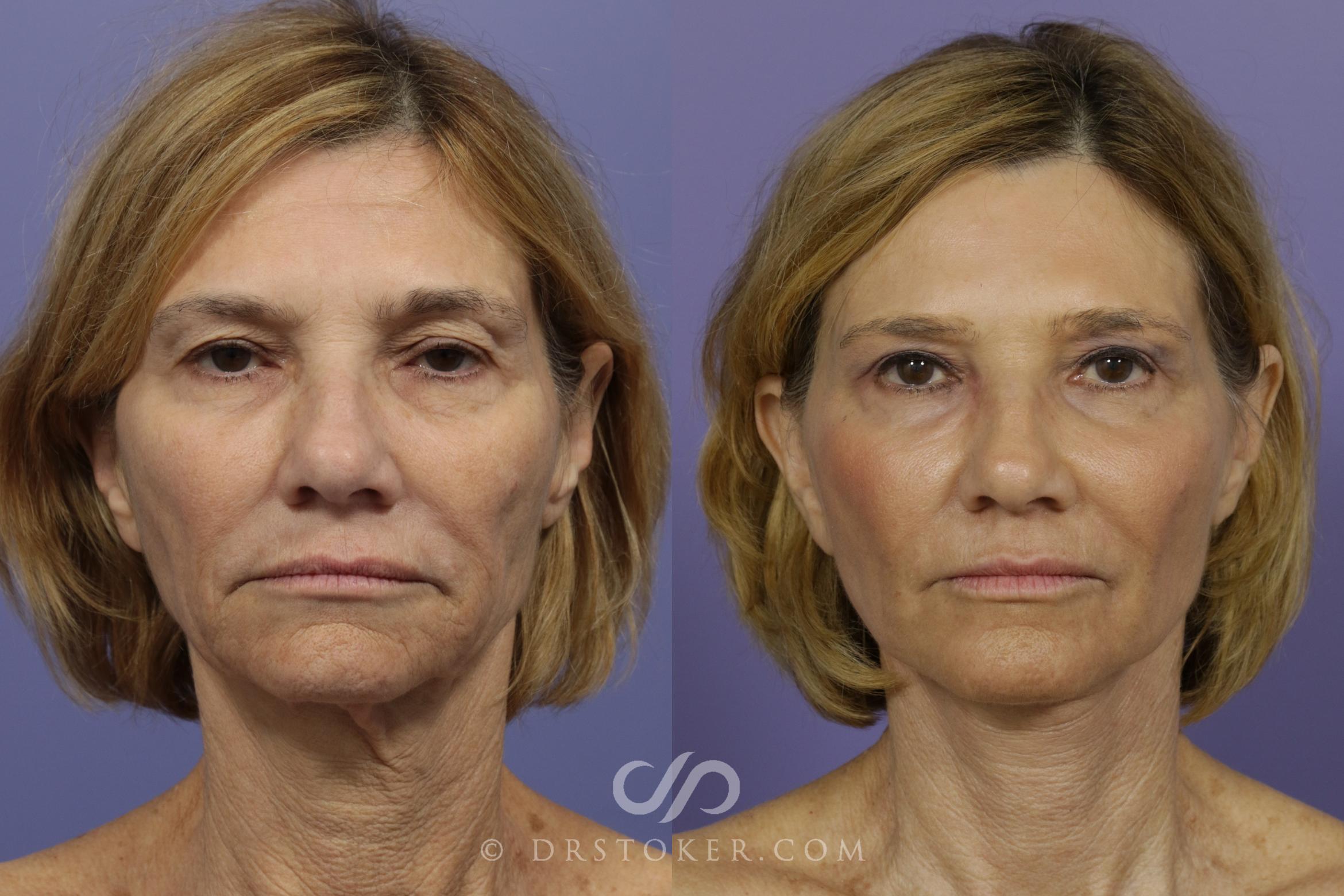 Before & After Facelift - Traceless Facelift Case 798 View #1 View in Los Angeles, CA