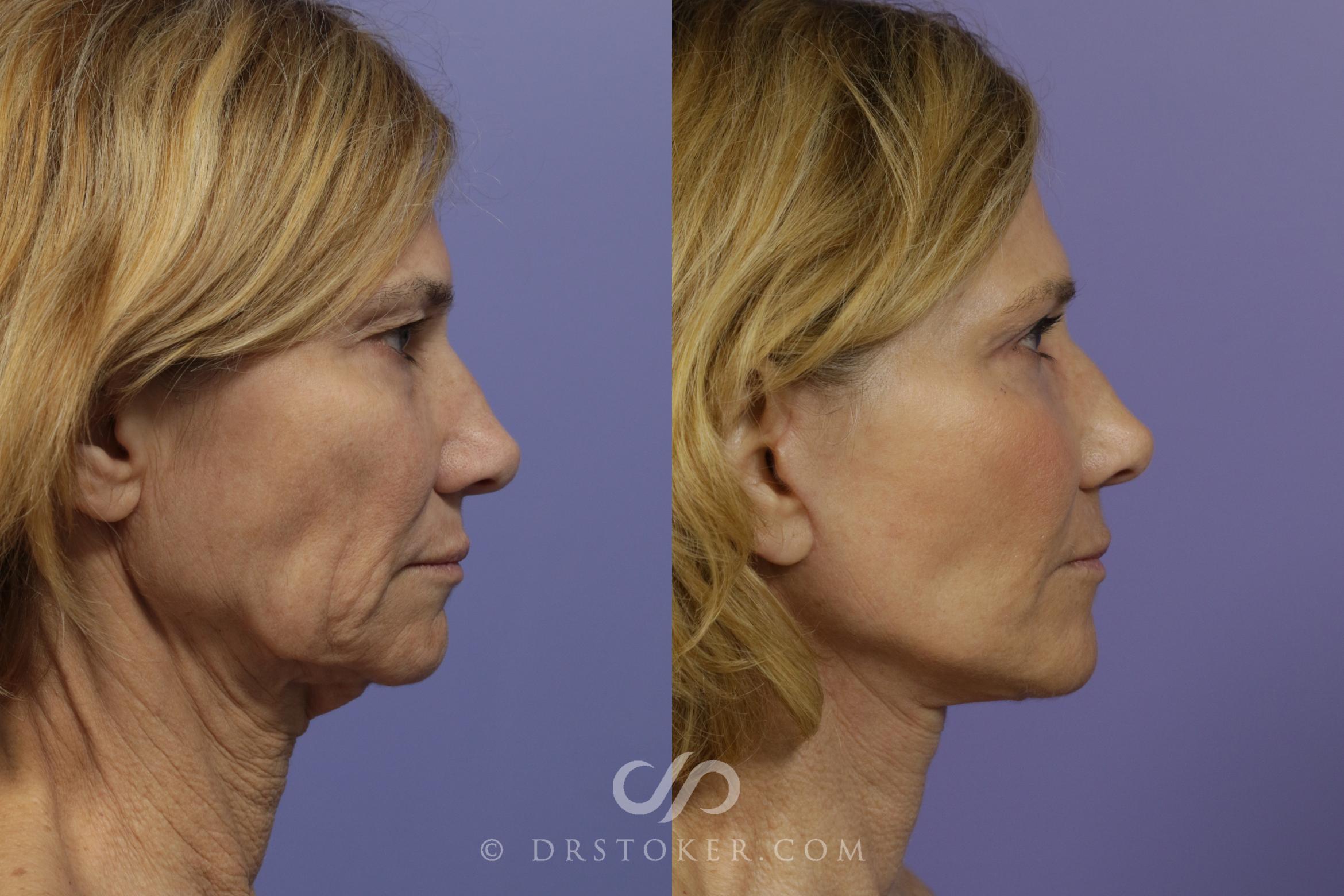 Before & After Facelift - Traceless Facelift Case 798 View #2 View in Los Angeles, CA