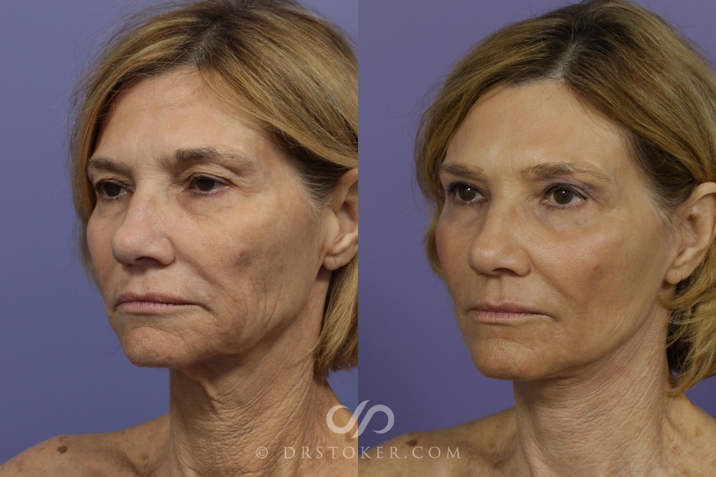 Before & After Facelift - Traceless Facelift Case 798 View #3 View in Los Angeles, CA