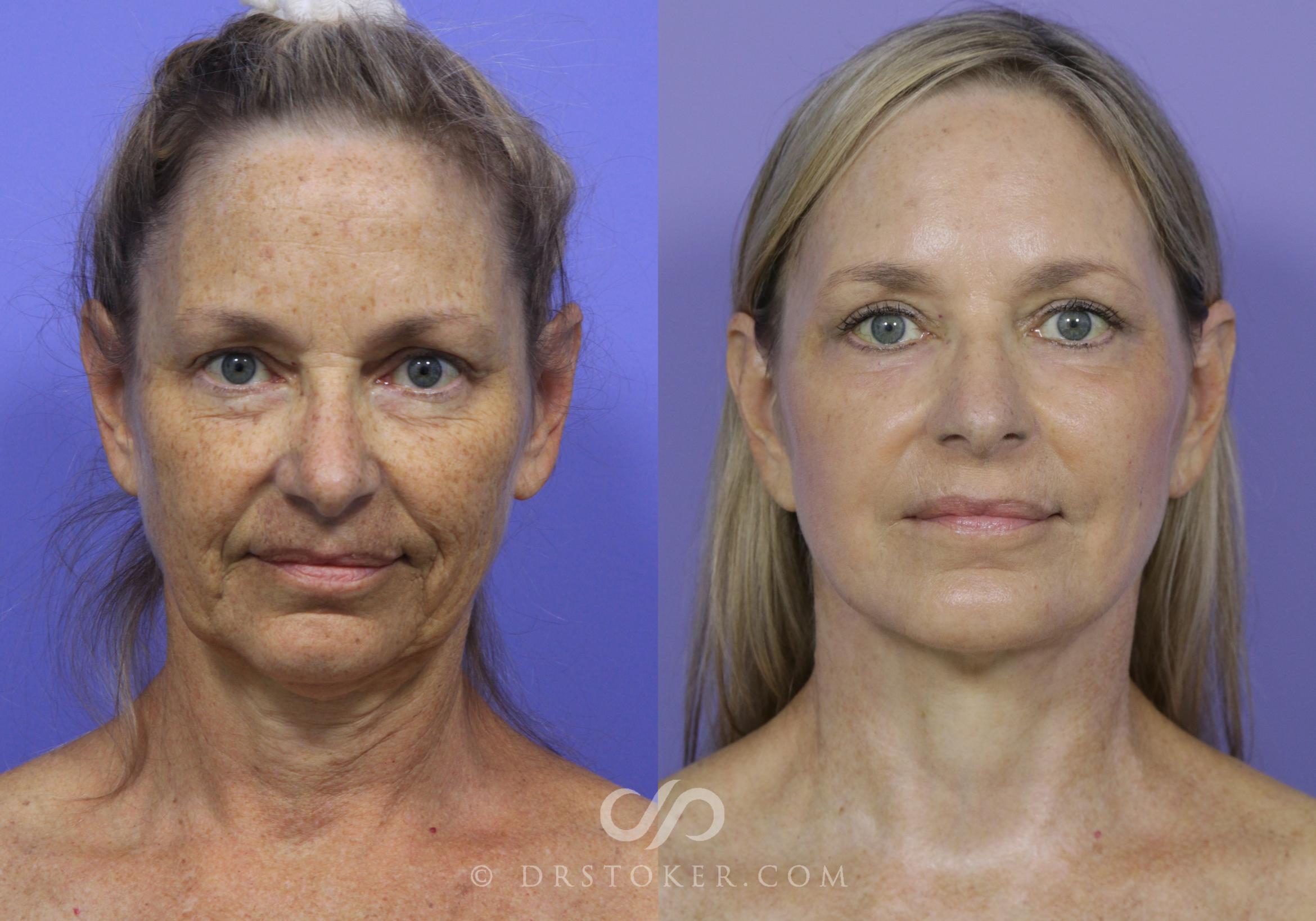 Facelift Case 809 Before After View # 1 / Los Angeles, CA / Dr. David Stoker