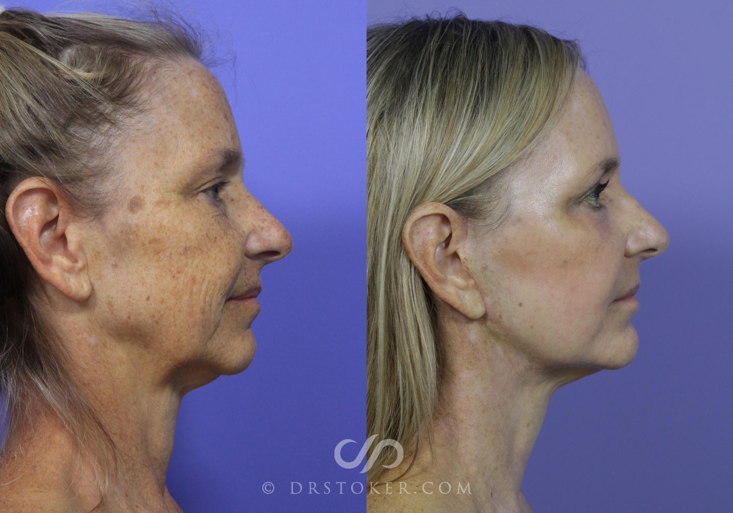 Before & After Facelift - Traceless Facelift Case 809 View #2 View in Los Angeles, CA