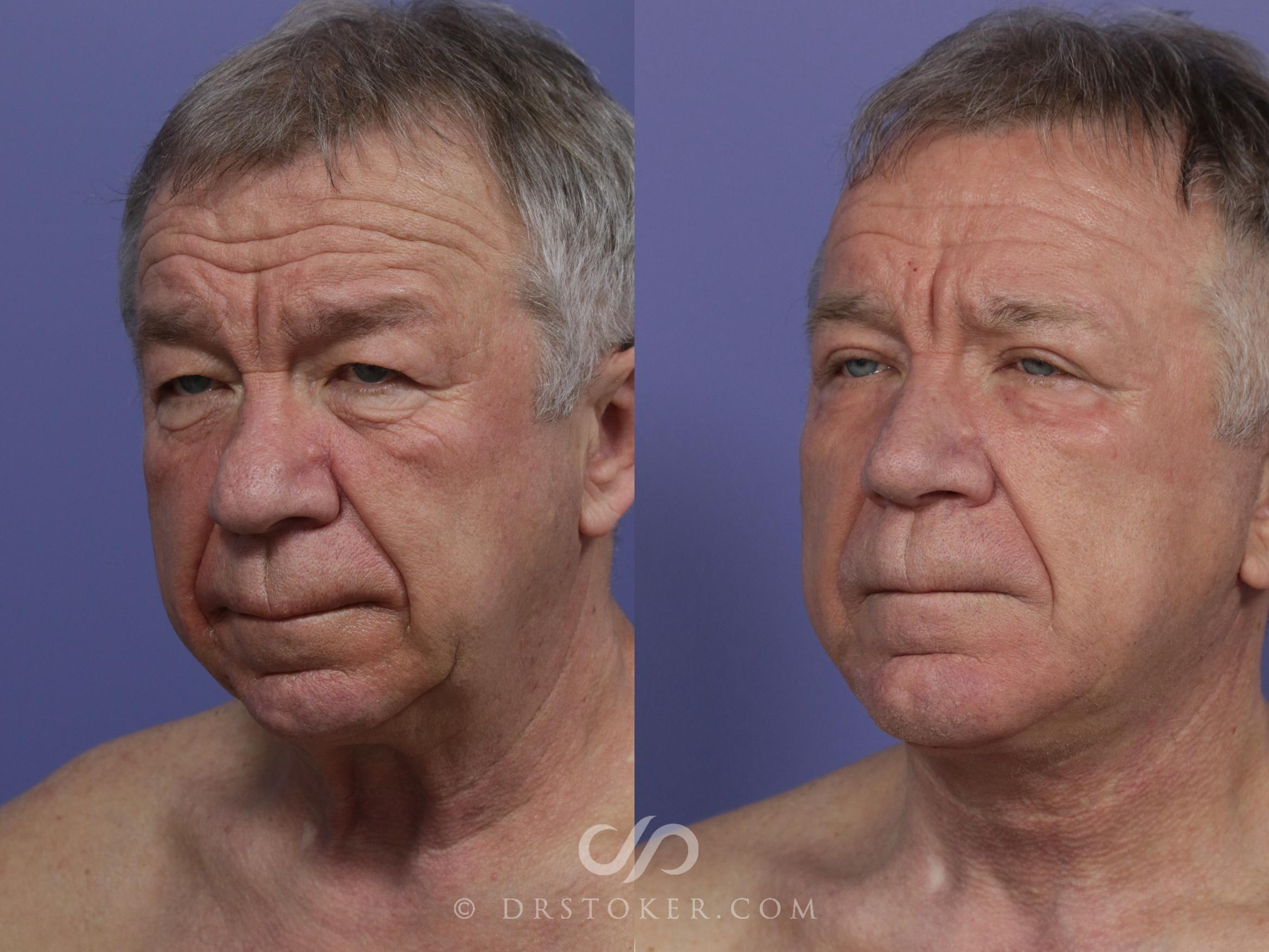 Before & After Facelift - Traceless Facelift Case 823 View #2 View in Los Angeles, CA