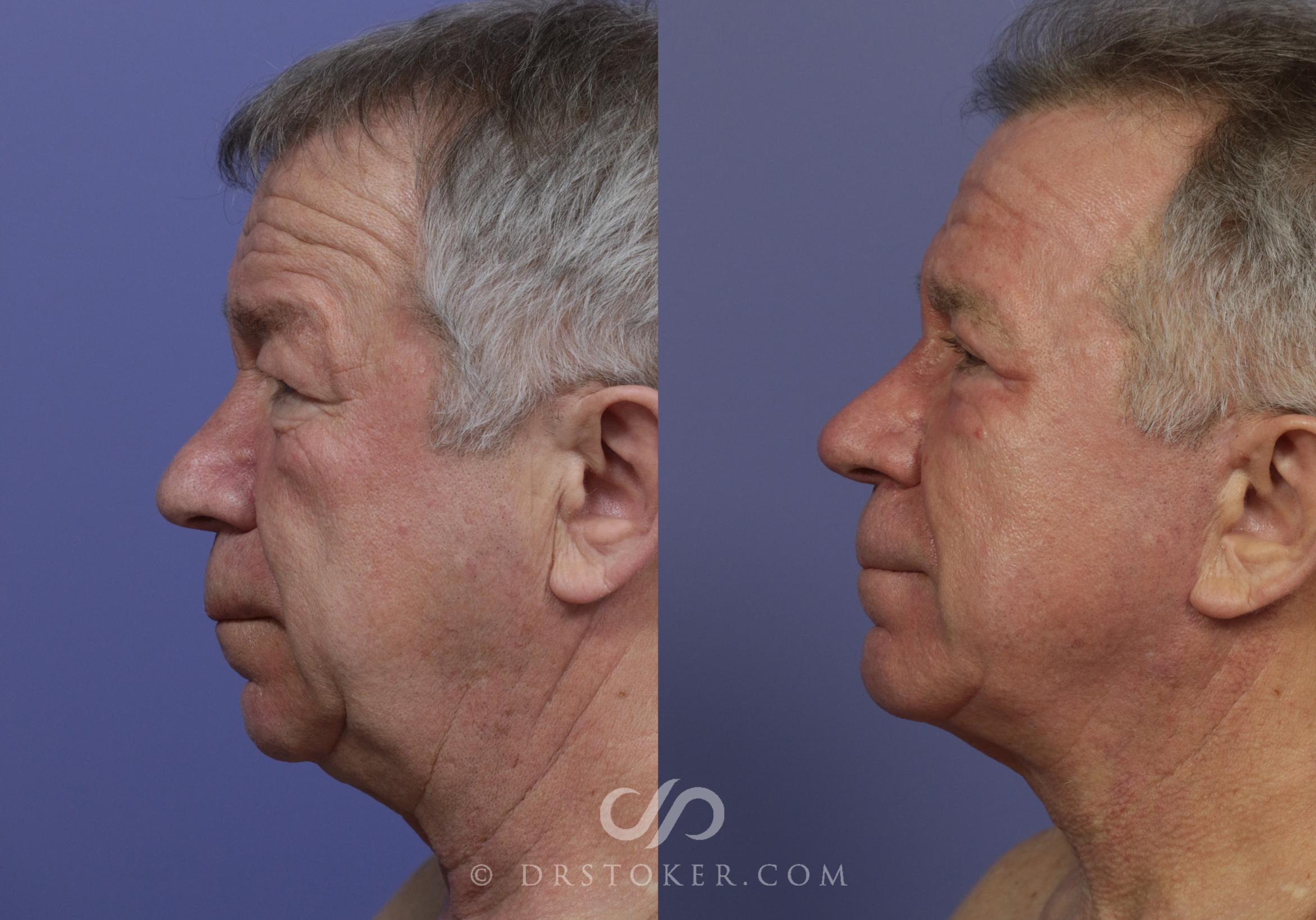 Before & After Facelift - Traceless Facelift Case 823 View #3 View in Los Angeles, CA