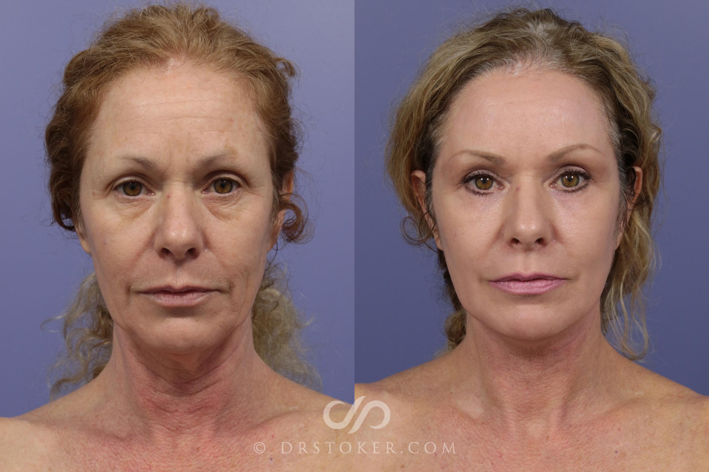 Before & After Facelift - Traceless Facelift Case 829 View #1 View in Los Angeles, CA