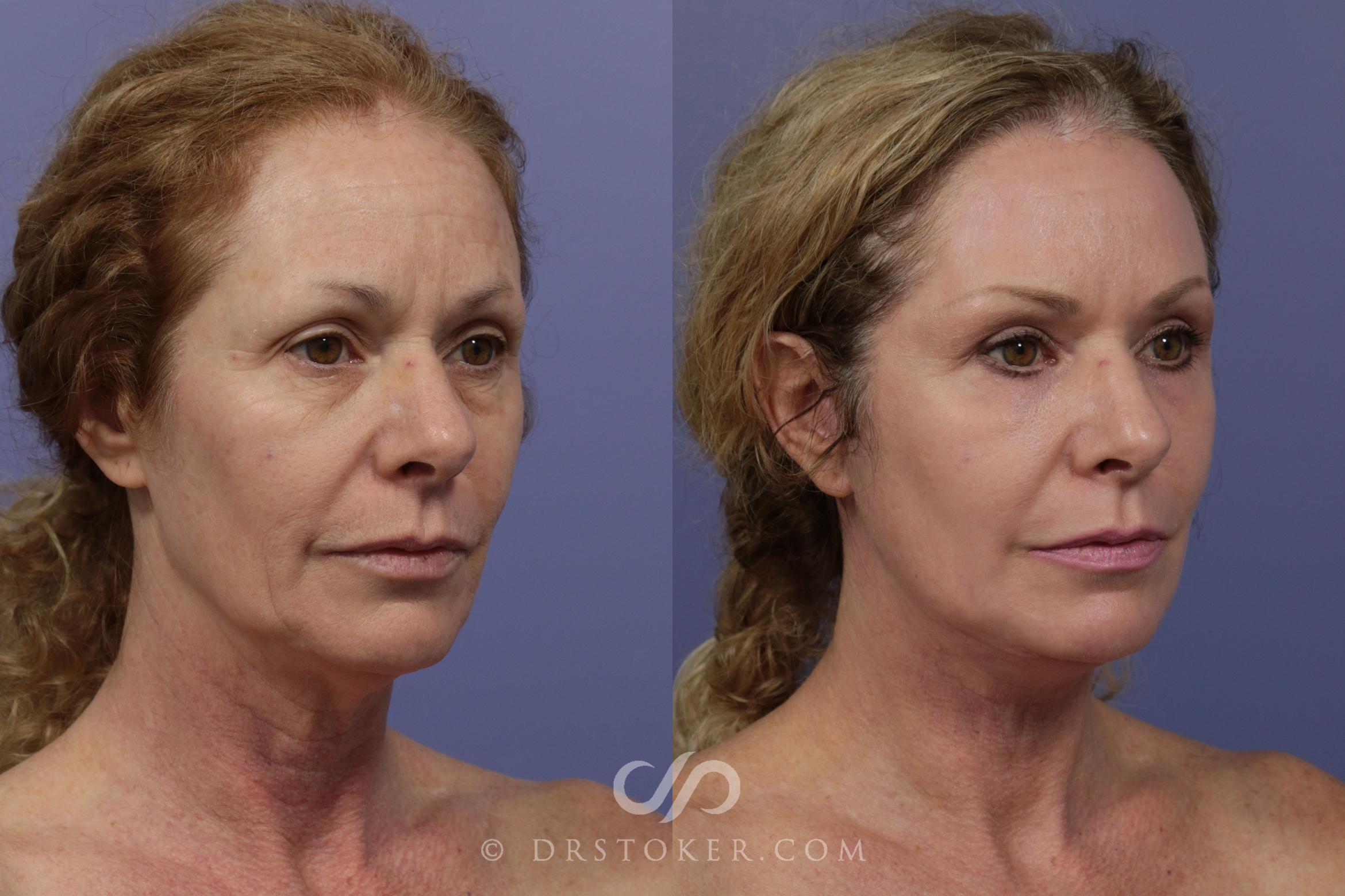 Before & After Facelift - Traceless Facelift Case 829 View #2 View in Los Angeles, CA