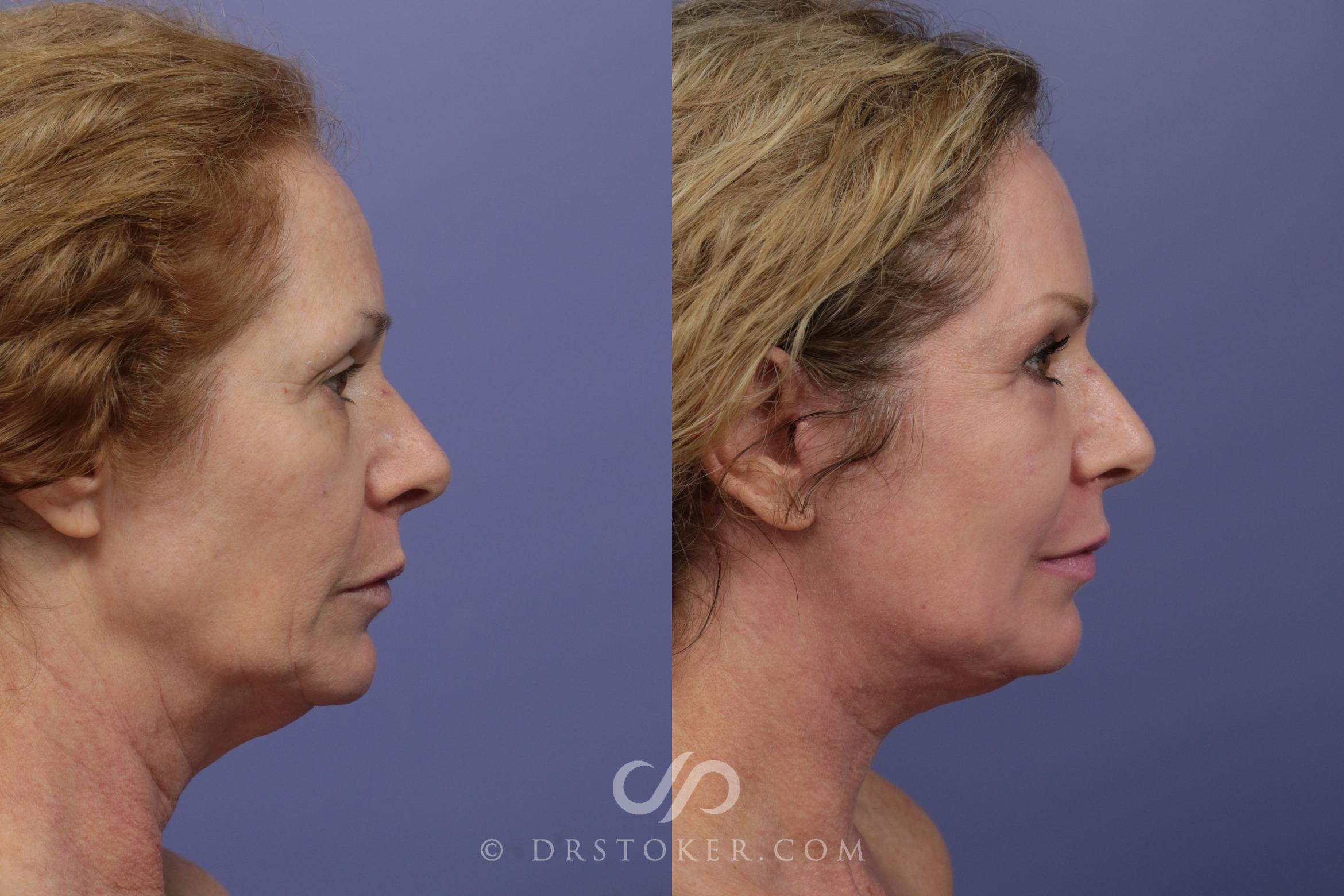 Before & After Facelift - Traceless Facelift Case 829 View #3 View in Los Angeles, CA