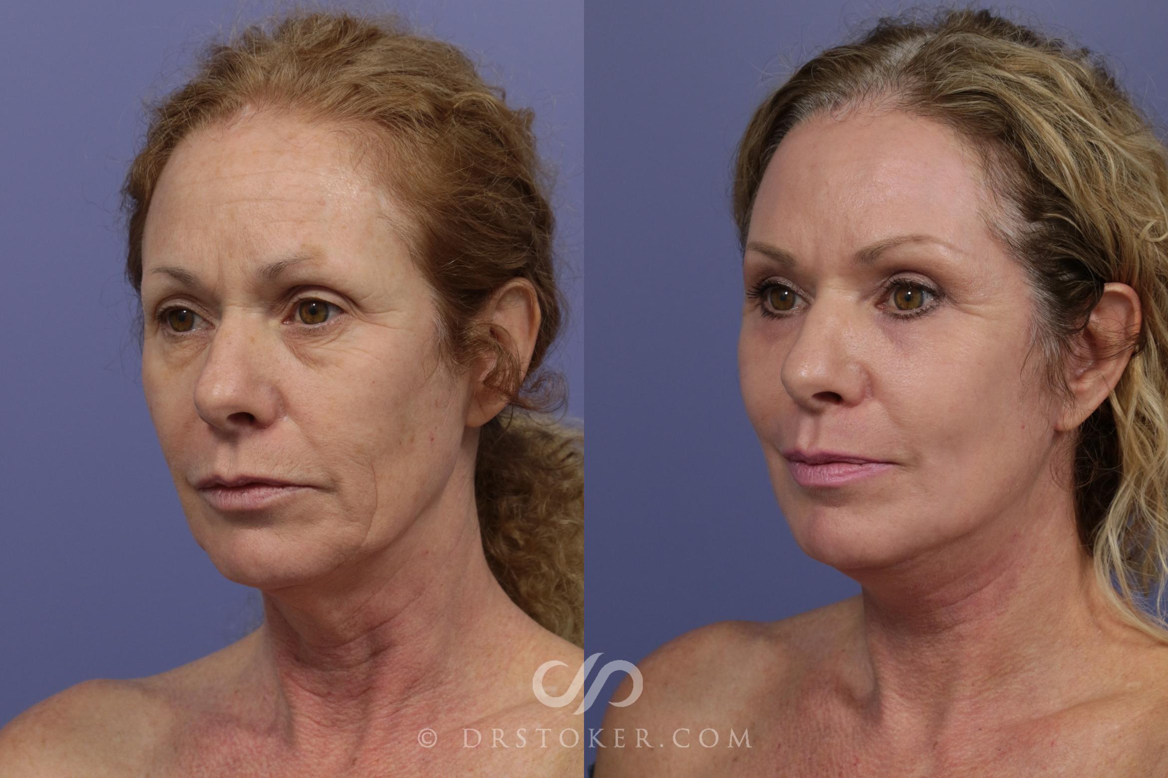 Before & After Facelift - Traceless Facelift Case 829 View #4 View in Los Angeles, CA