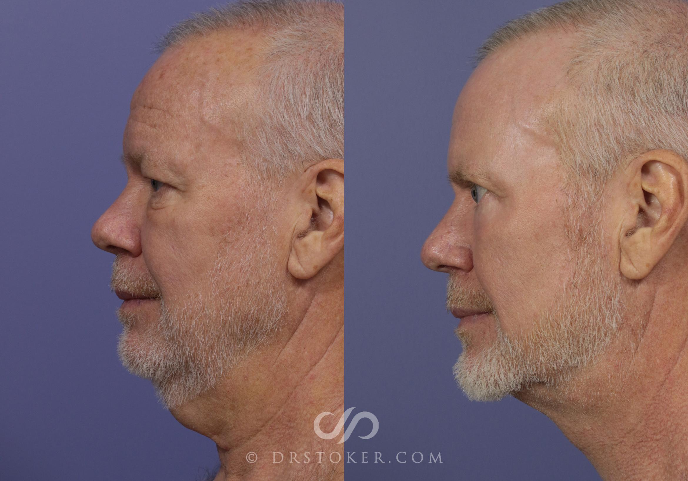 Before & After Facelift - Traceless Facelift Case 833 View #2 View in Los Angeles, CA