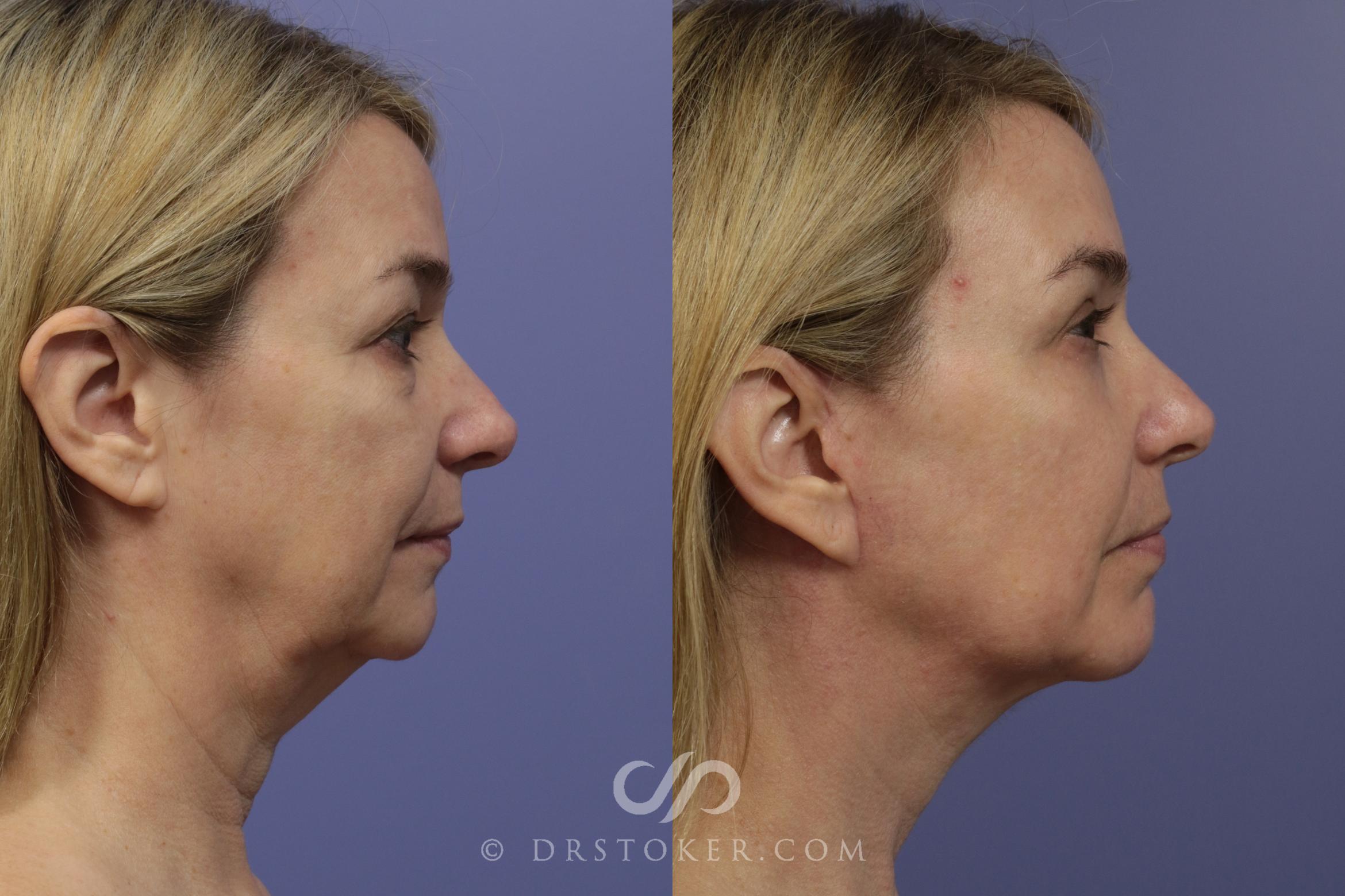 Before & After Facelift - Traceless Facelift Case 836 View #3 View in Los Angeles, CA