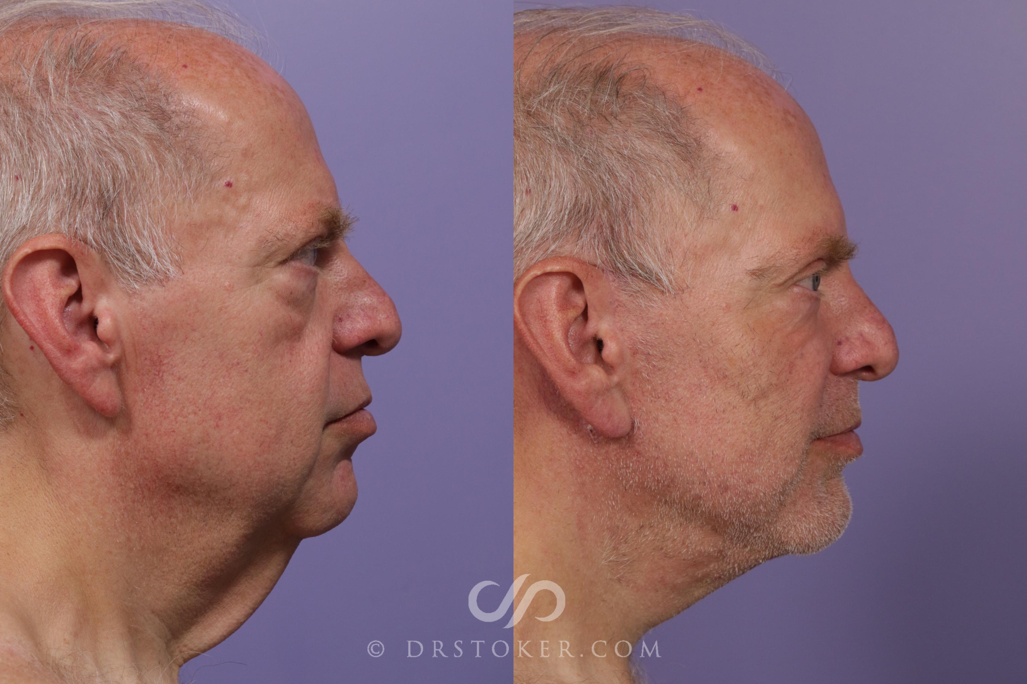 Before & After Facelift for Men Case 1733 Right Side View in Los Angeles, CA