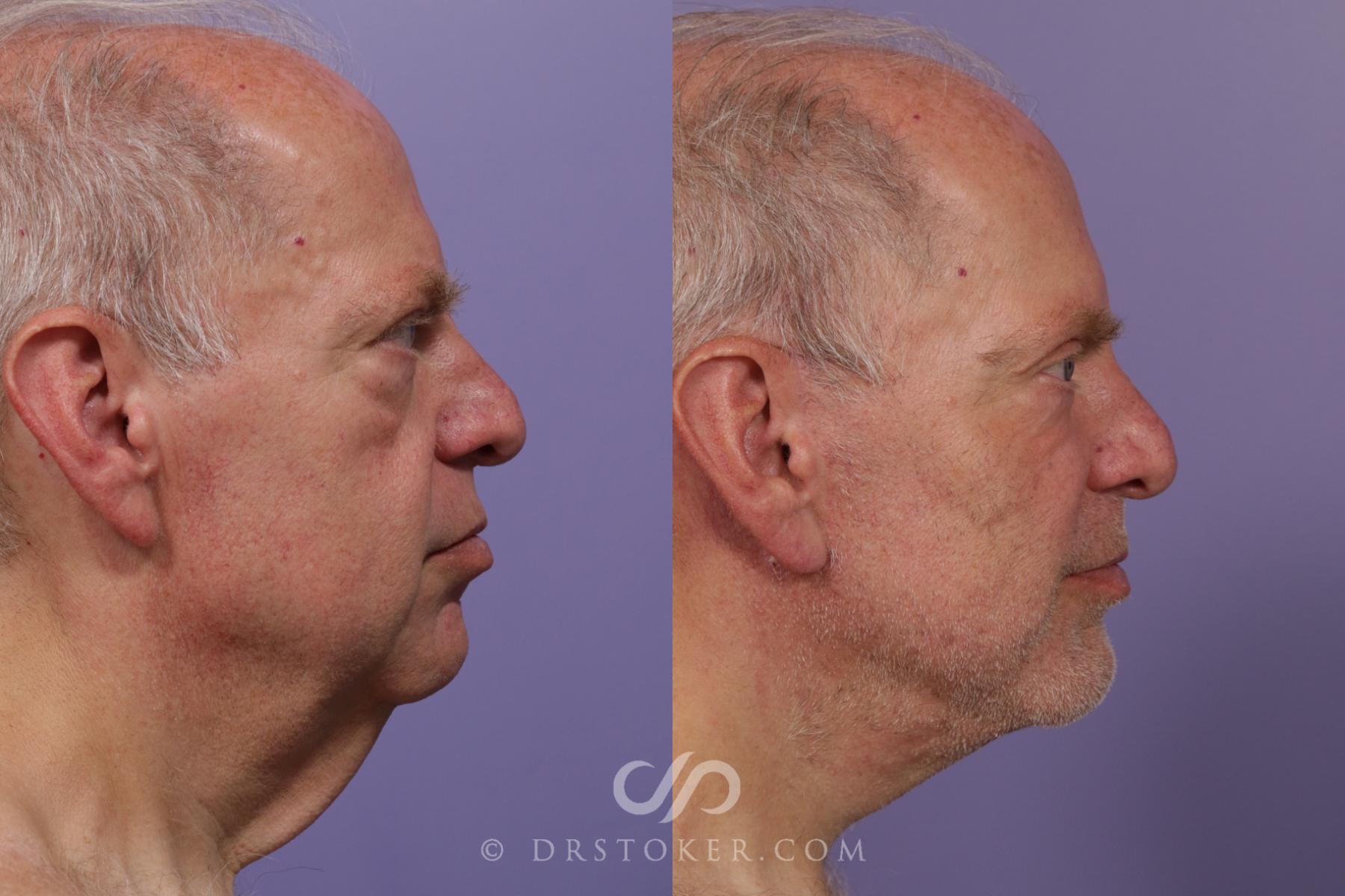 Before & After Facelift - Traceless Facelift Case 1733 Right Side View in Los Angeles, CA