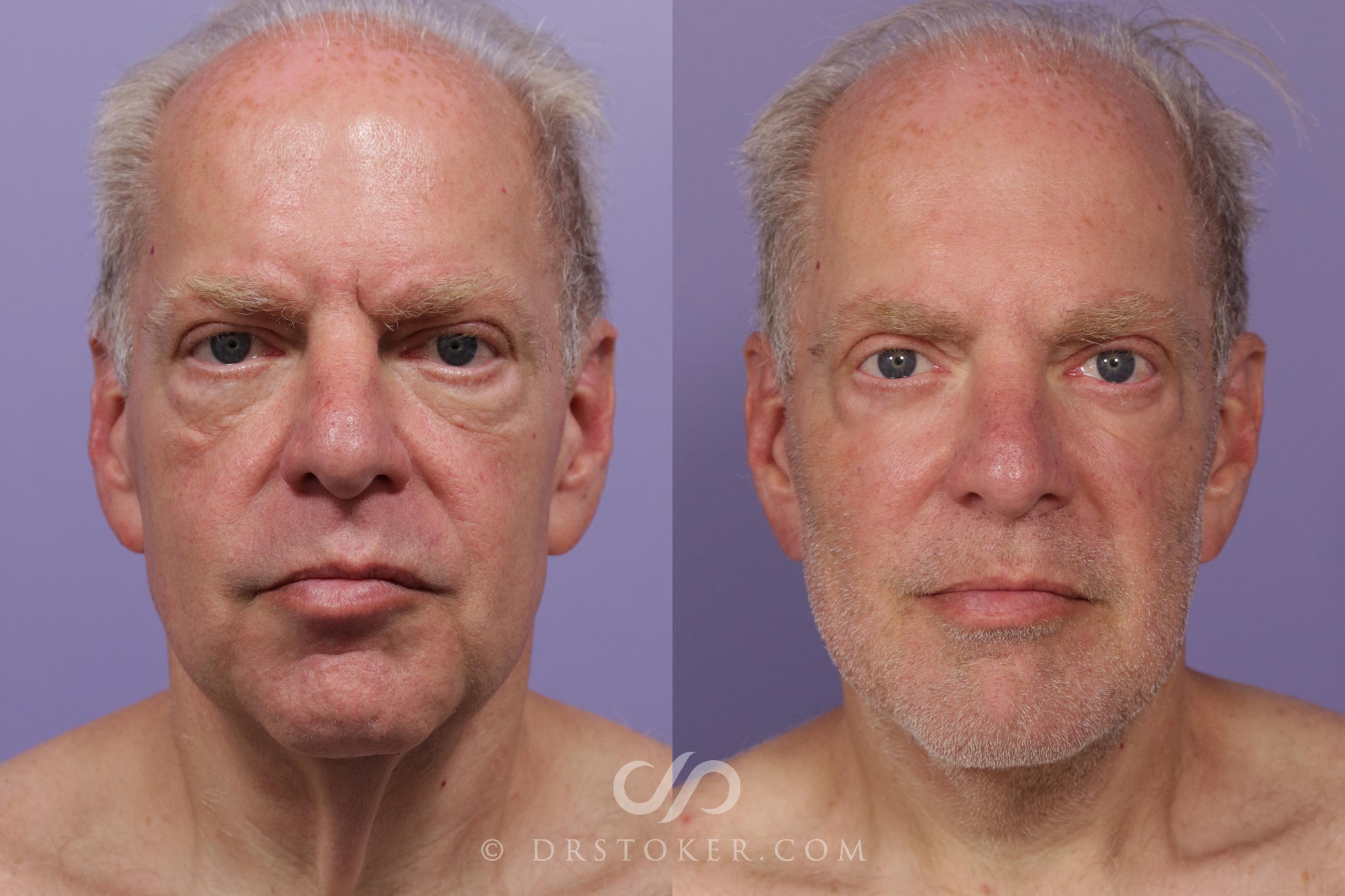Before & After Neck Lift for Men Case 1733 View #1 View in Marina del Rey, CA