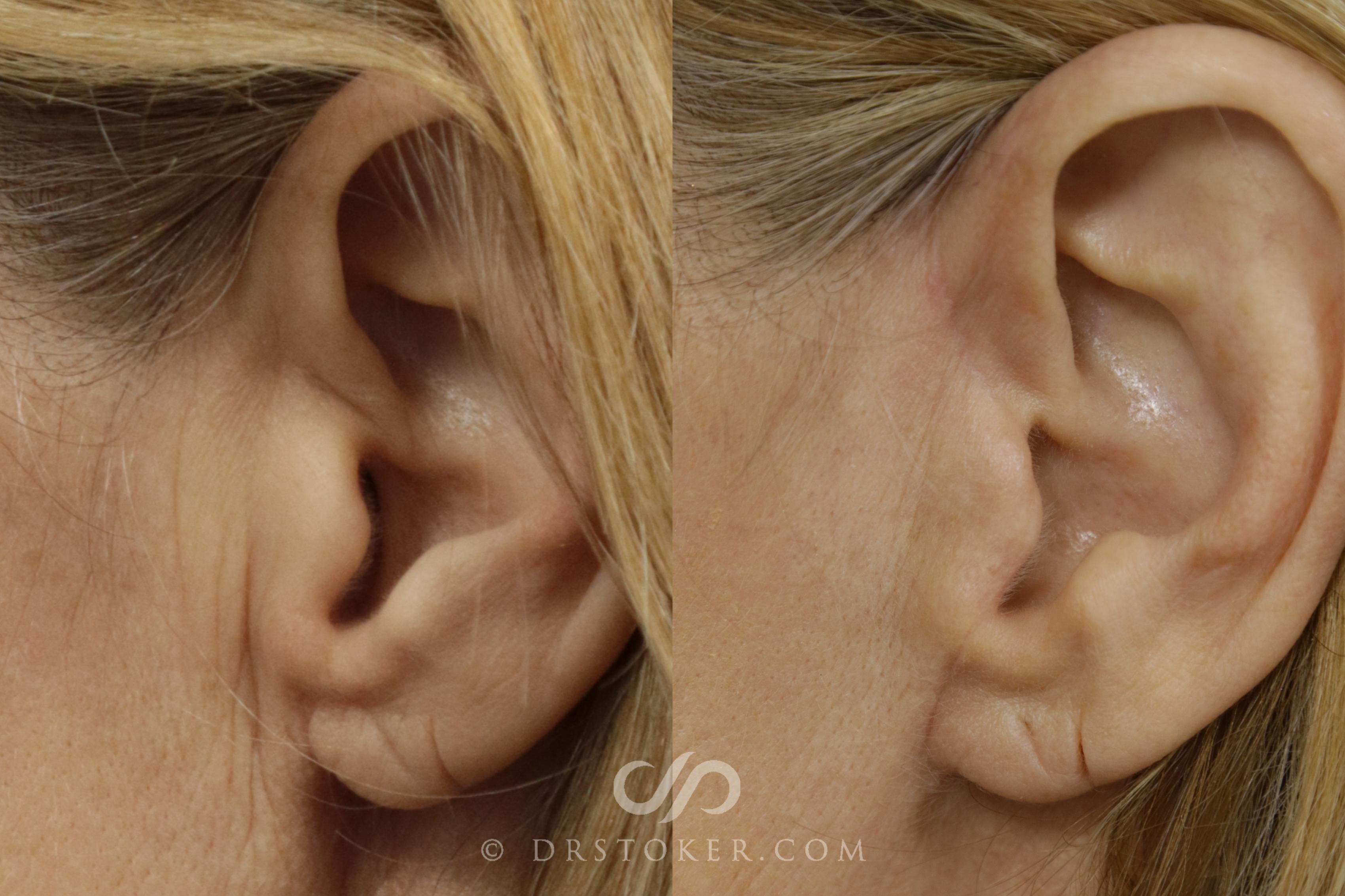 Before & After Facelift Incisions (Hidden Scars)  Case 1432 View #1 View in Los Angeles, CA