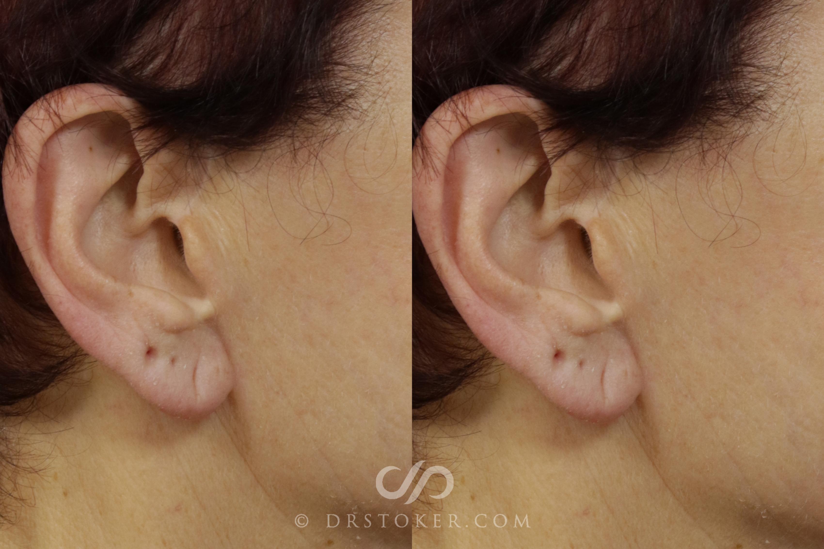 Before & After Facelift Incisions (Hidden Scars)  Case 1435 View #1 View in Los Angeles, CA