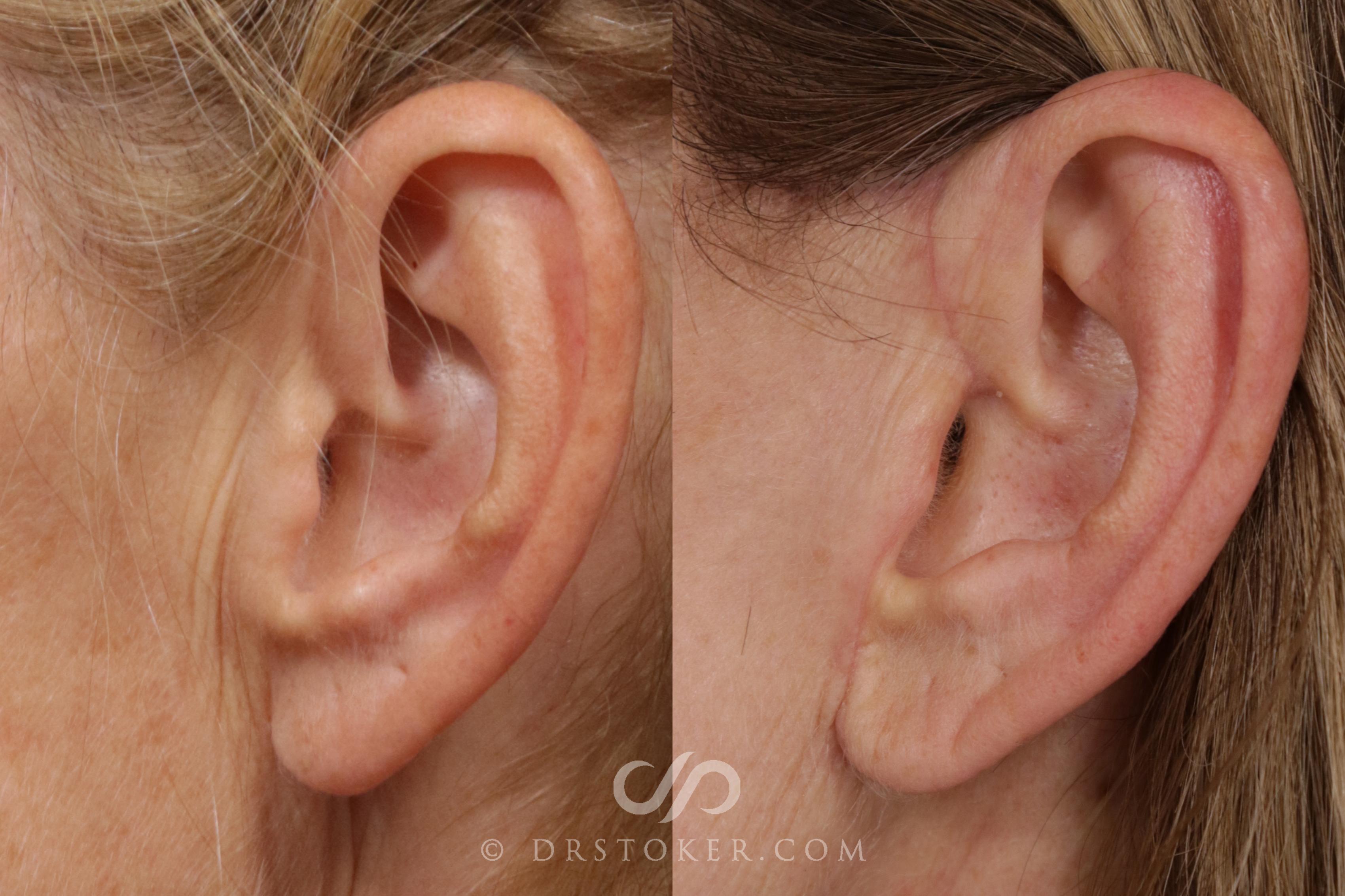 Before & After Facelift Incisions (Hidden Scars)  Case 1843 Left Side View in Los Angeles, CA
