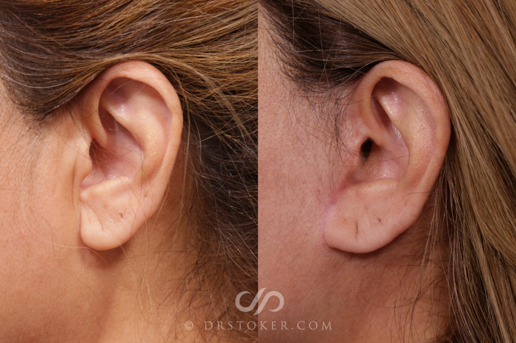 Before & After Facelift Incisions (Hidden Scars)  Case 2120 Left Side View in Los Angeles, CA