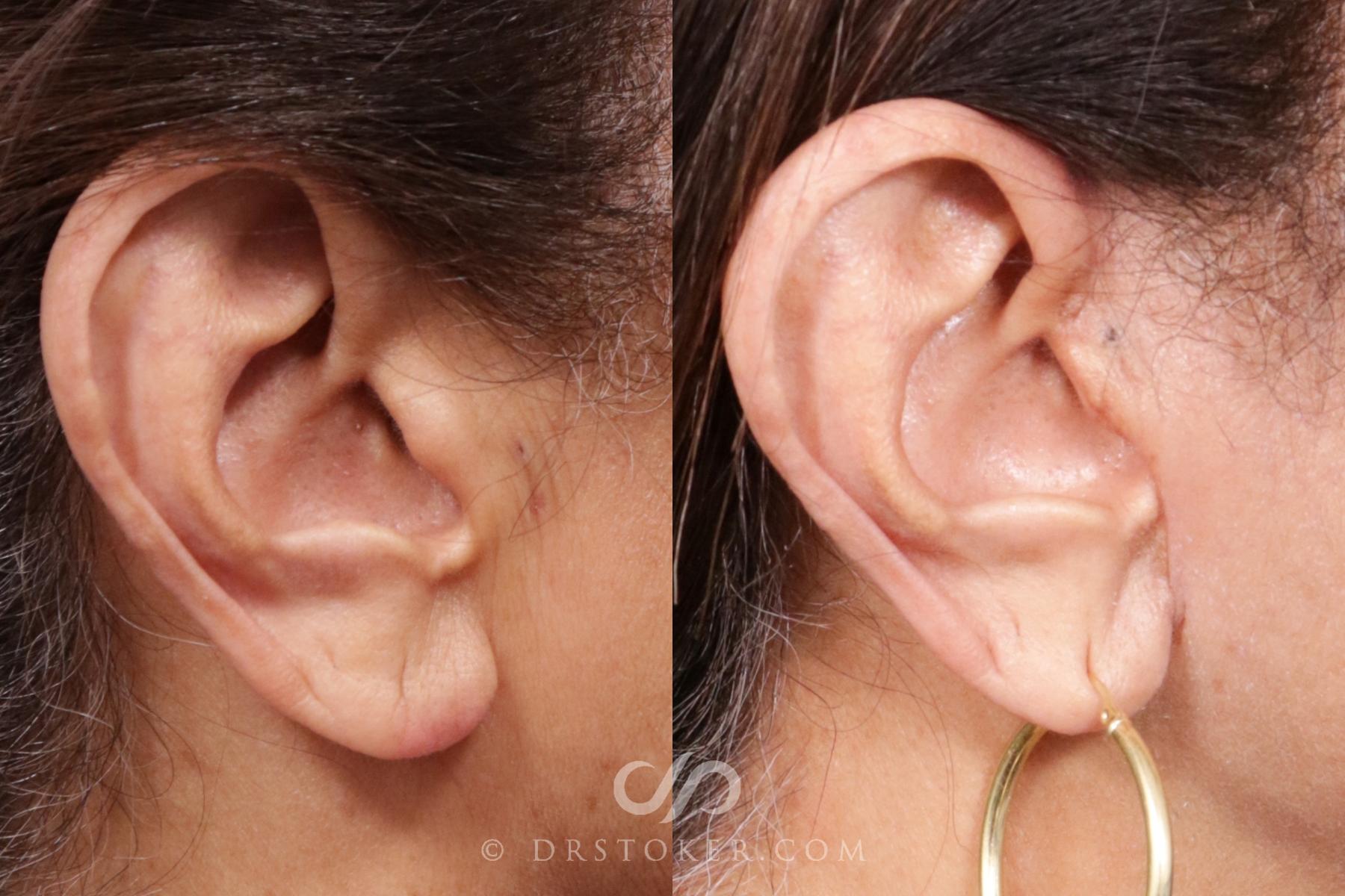 Before & After Facelift Incisions (Hidden Scars)  Case 2147 Right Side View in Los Angeles, CA