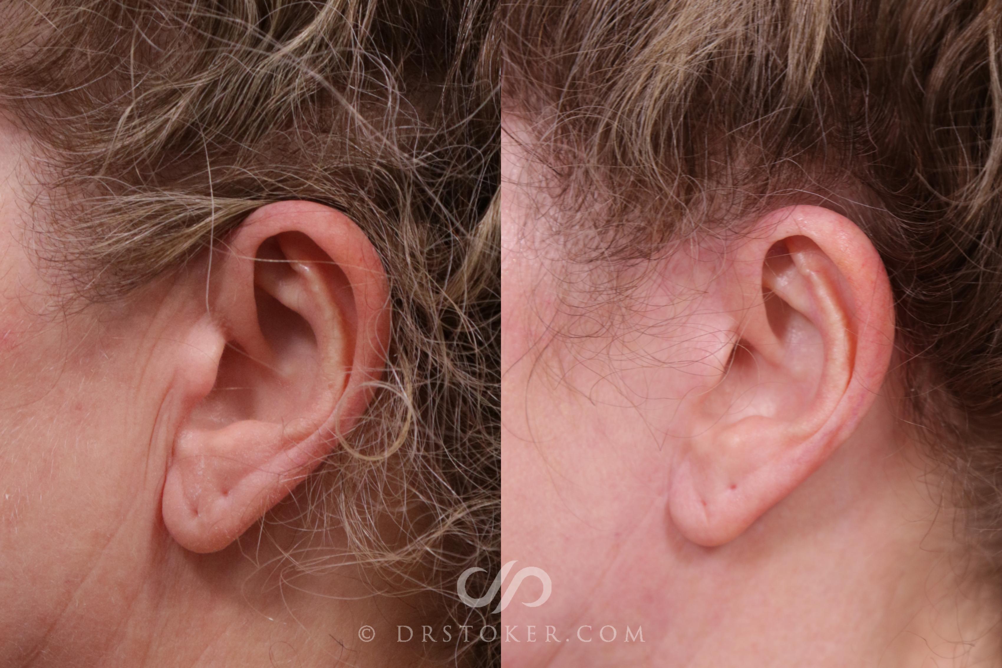 Before & After Facelift Incisions (Hidden Scars)  Case 2205 Left Side View in Los Angeles, CA