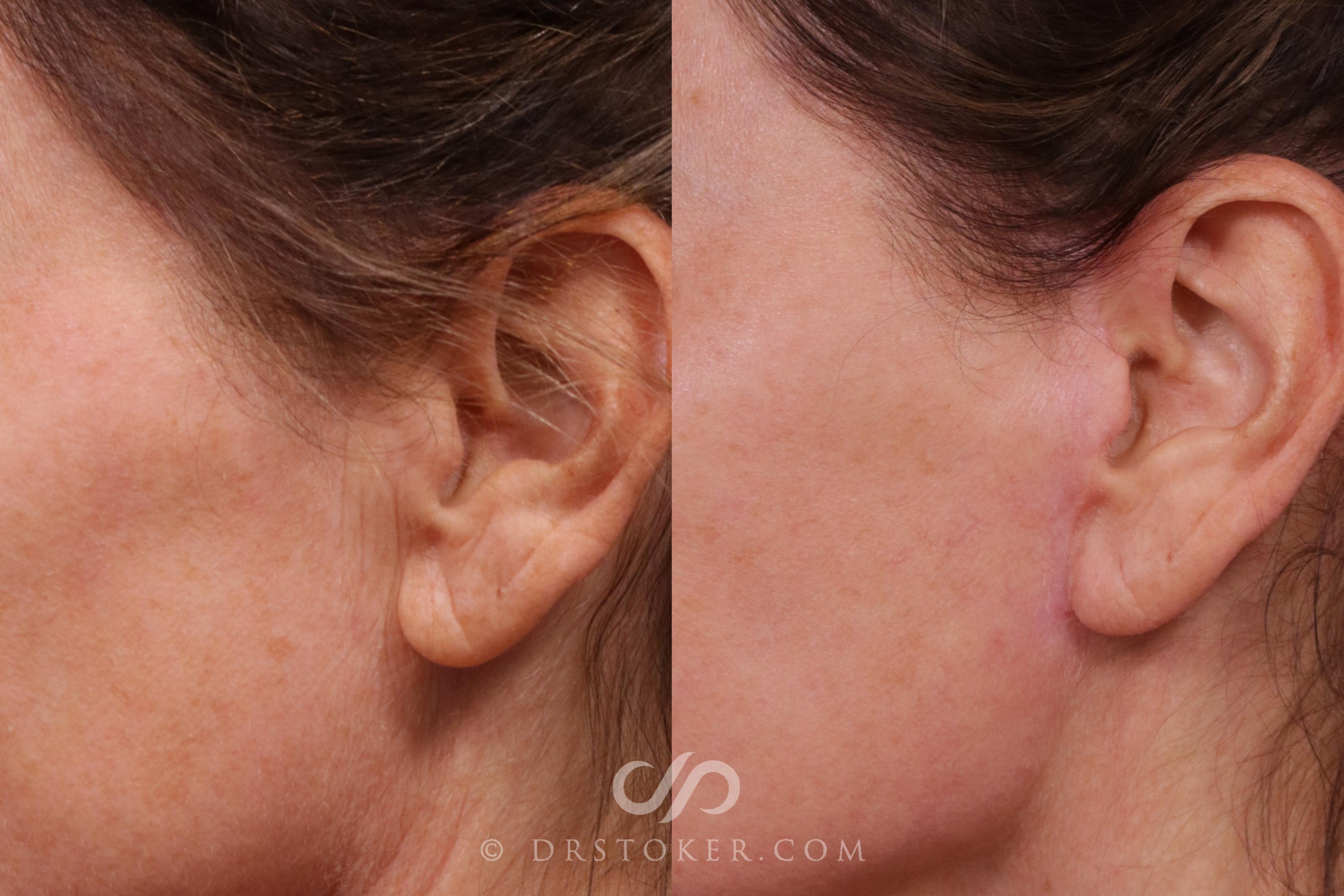 Before & After Facelift Incisions (Hidden Scars)  Case 2228 Left Side View in Los Angeles, CA