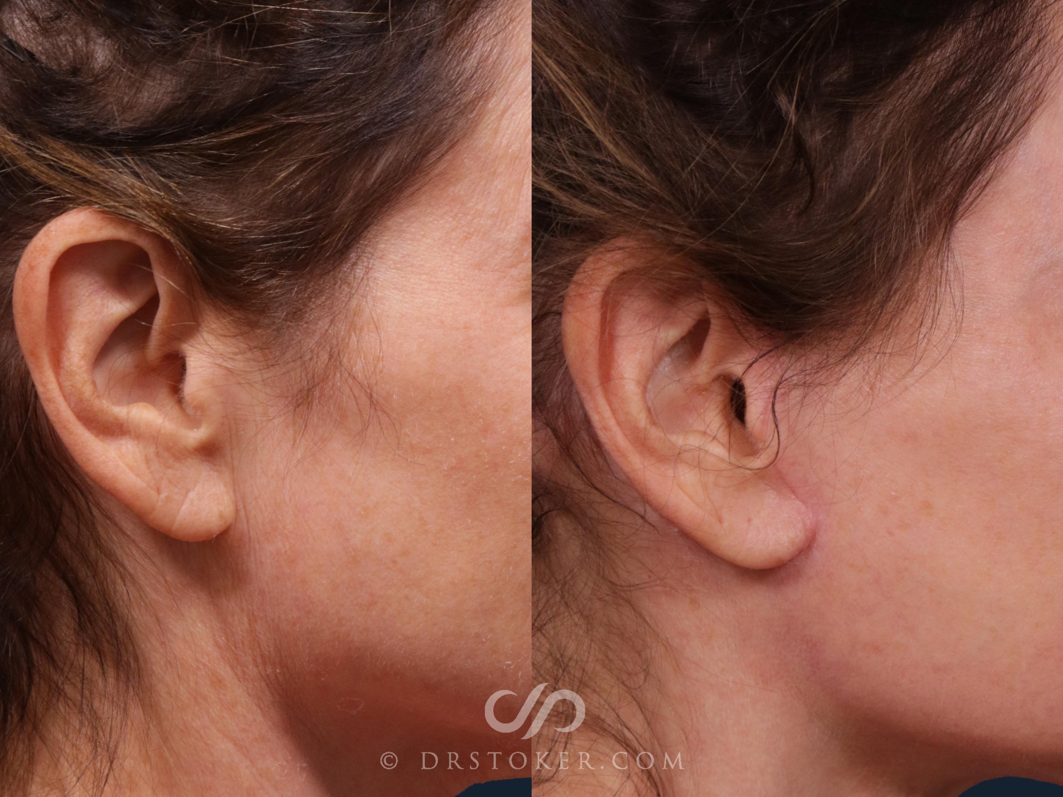 Before & After Facelift Incisions (Hidden Scars)  Case 2229 Right Side View in Los Angeles, CA