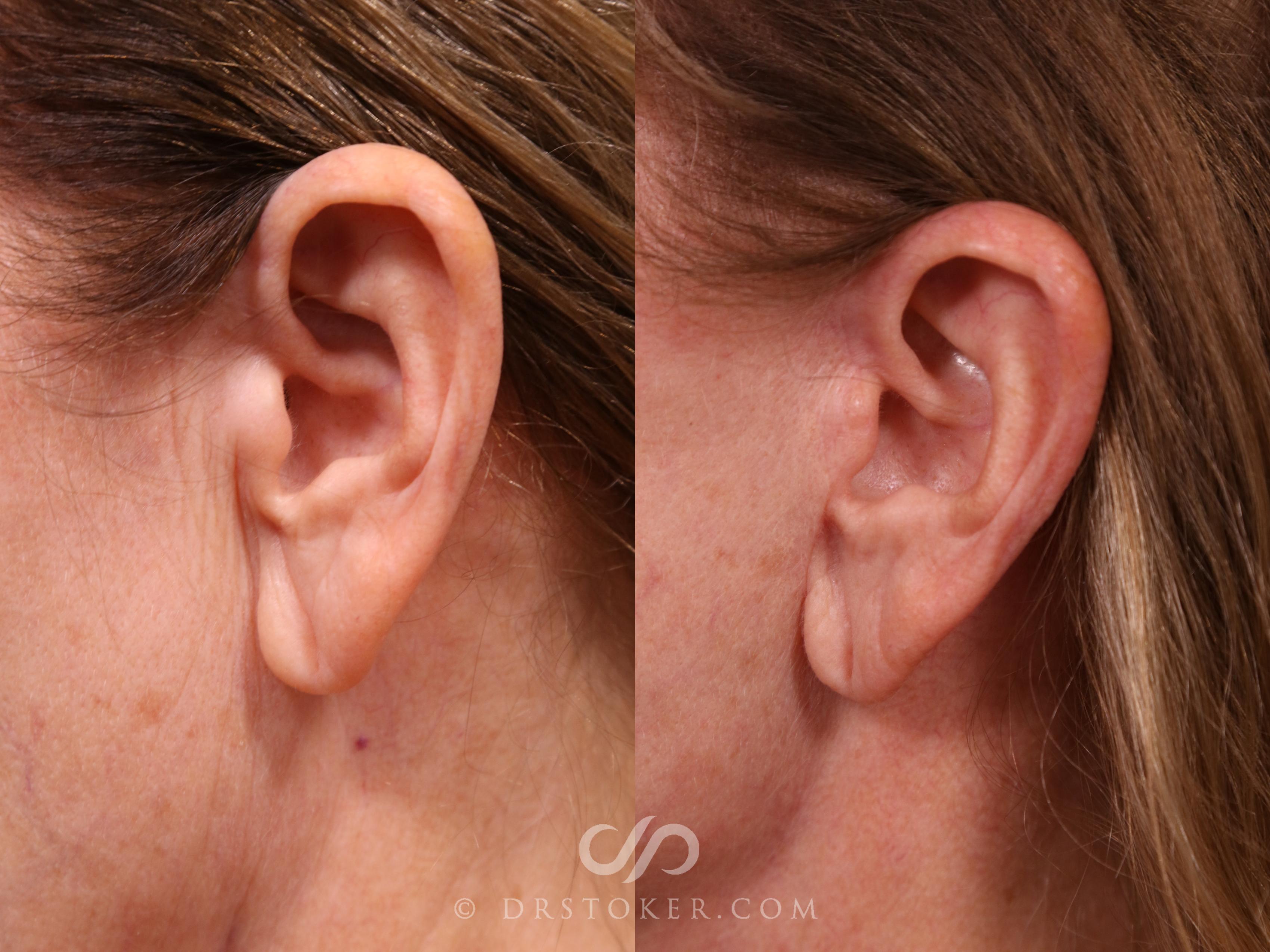 Before & After Facelift Incisions (Hidden Scars)  Case 2309 Left Side View in Los Angeles, CA