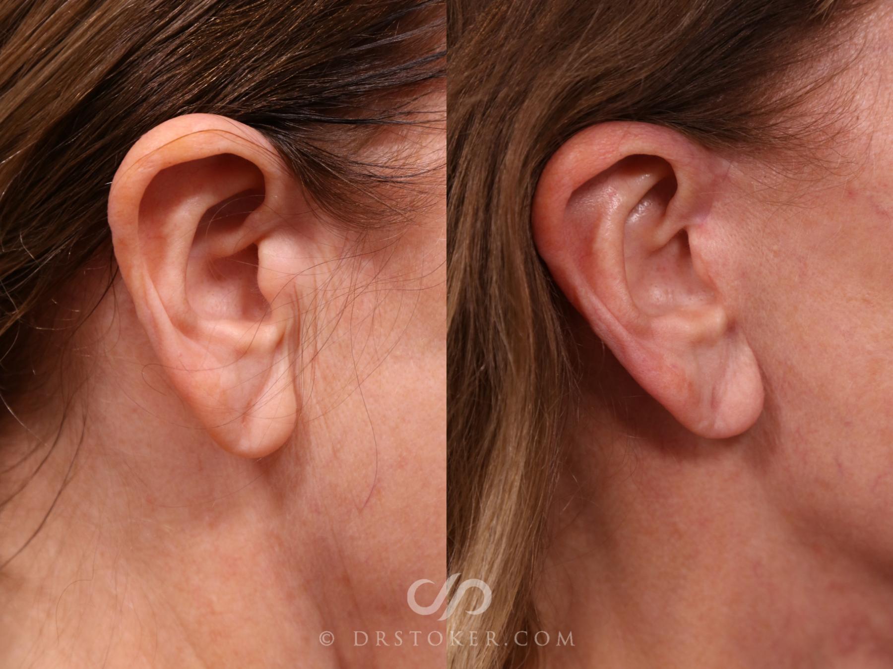 Before & After Facelift Incisions (Hidden Scars)  Case 2310 Right Side View in Los Angeles, CA