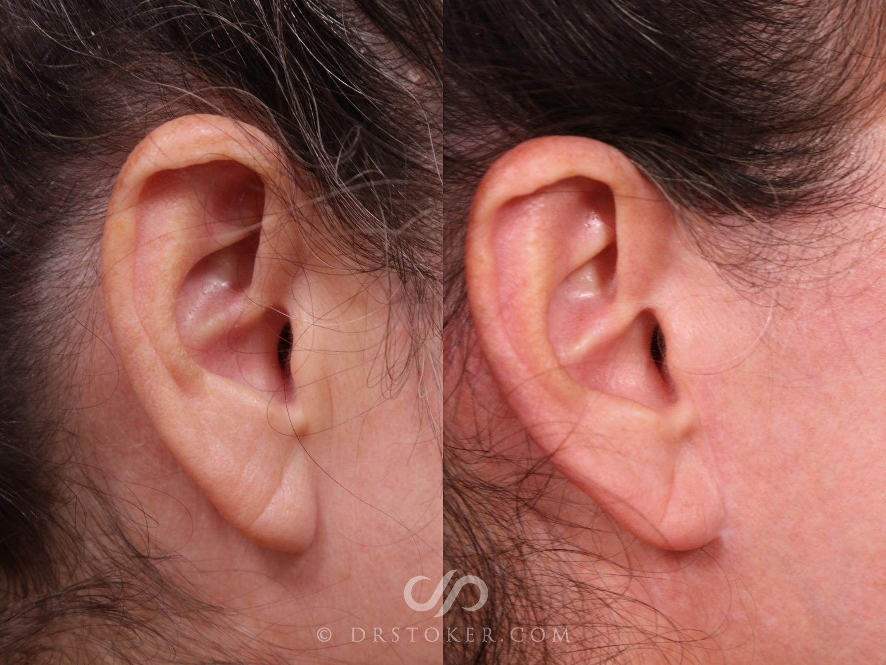 Before & After Facelift Incisions (Hidden Scars)  Case 2312 Right Side View in Los Angeles, CA