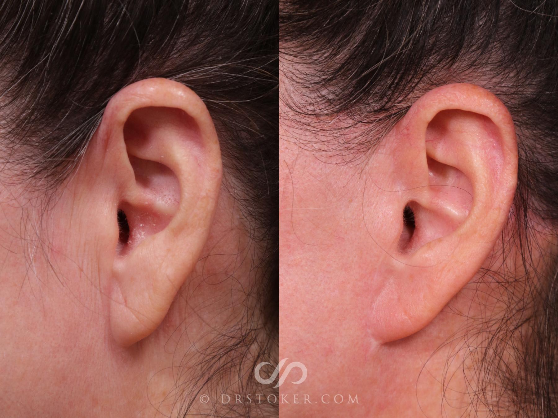 Before & After Facelift Incisions (Hidden Scars)  Case 2314 Left Side View in Los Angeles, CA