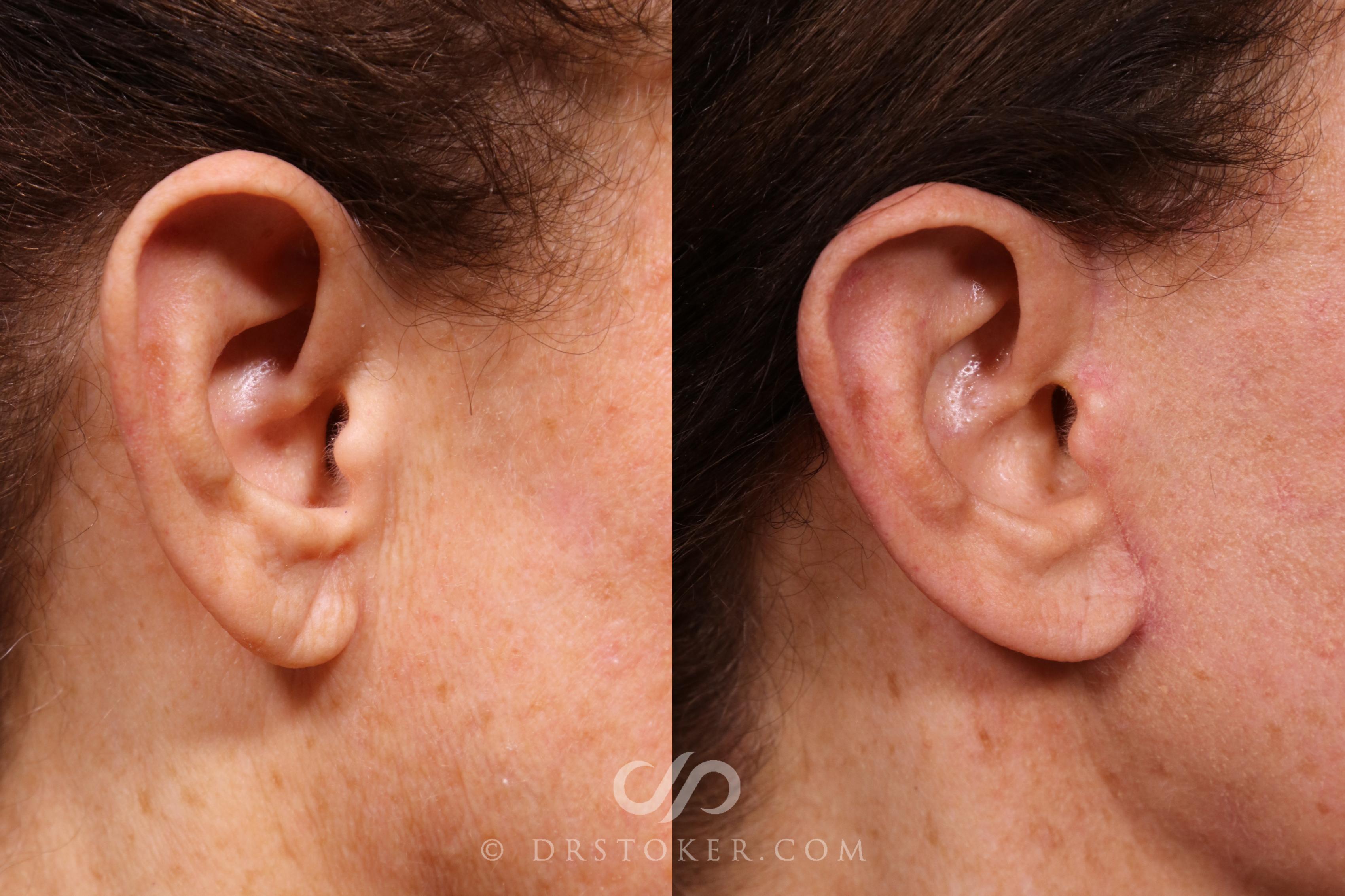 Before & After Facelift Incisions (Hidden Scars)  Case 2374 Right Side View in Los Angeles, CA