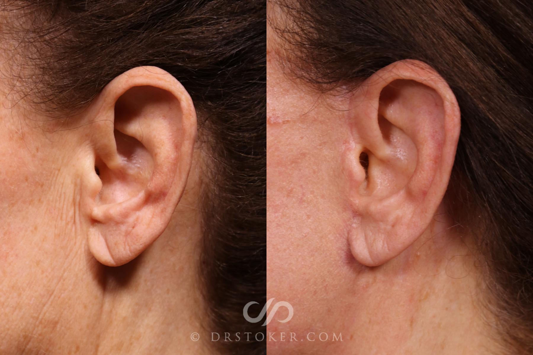 Before & After Facelift Incisions (Hidden Scars)  Case 2375 Left Side View in Los Angeles, CA