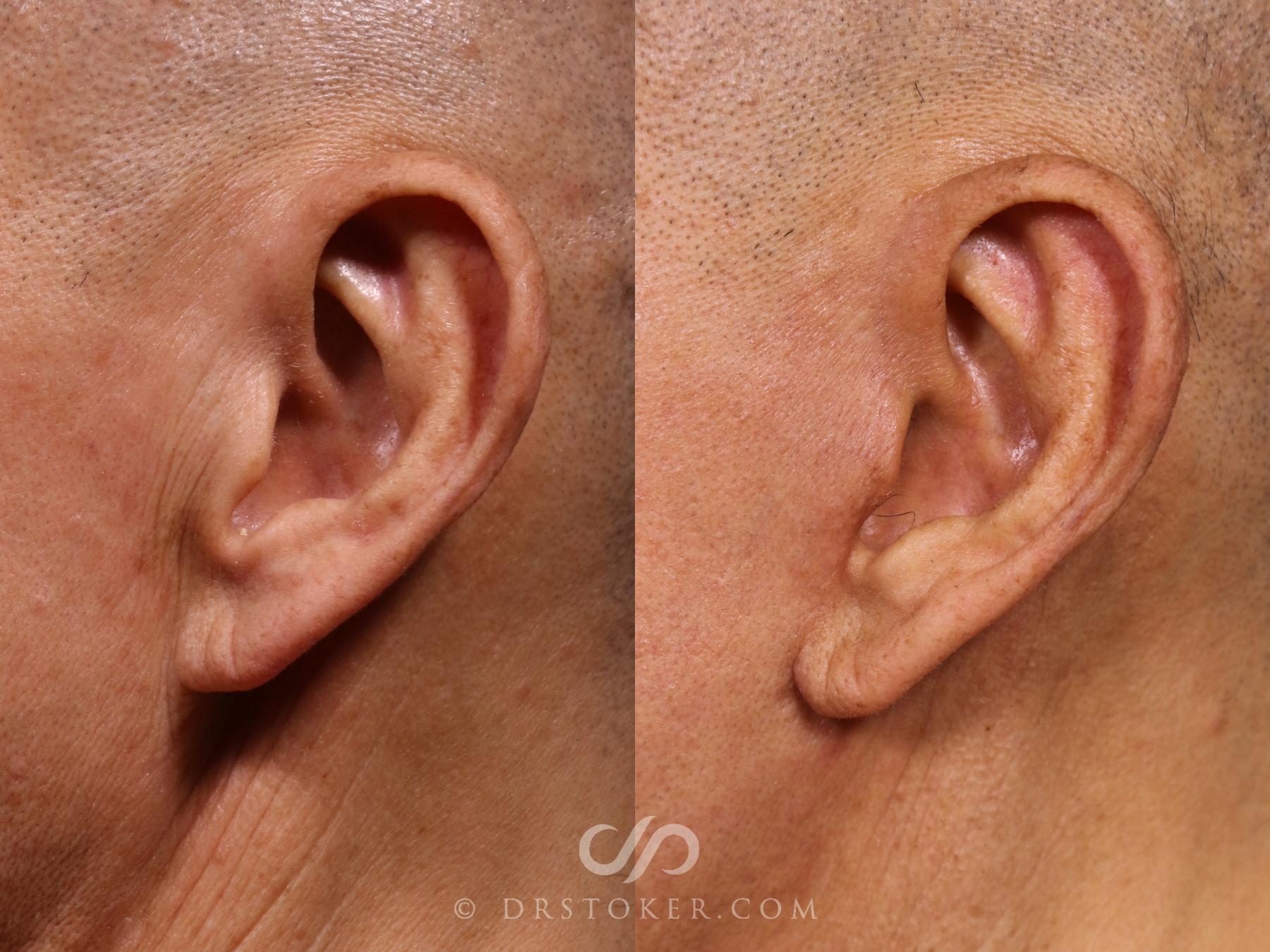 Before & After Facelift Incisions (Hidden Scars)  Case 2380 Left Side View in Los Angeles, CA