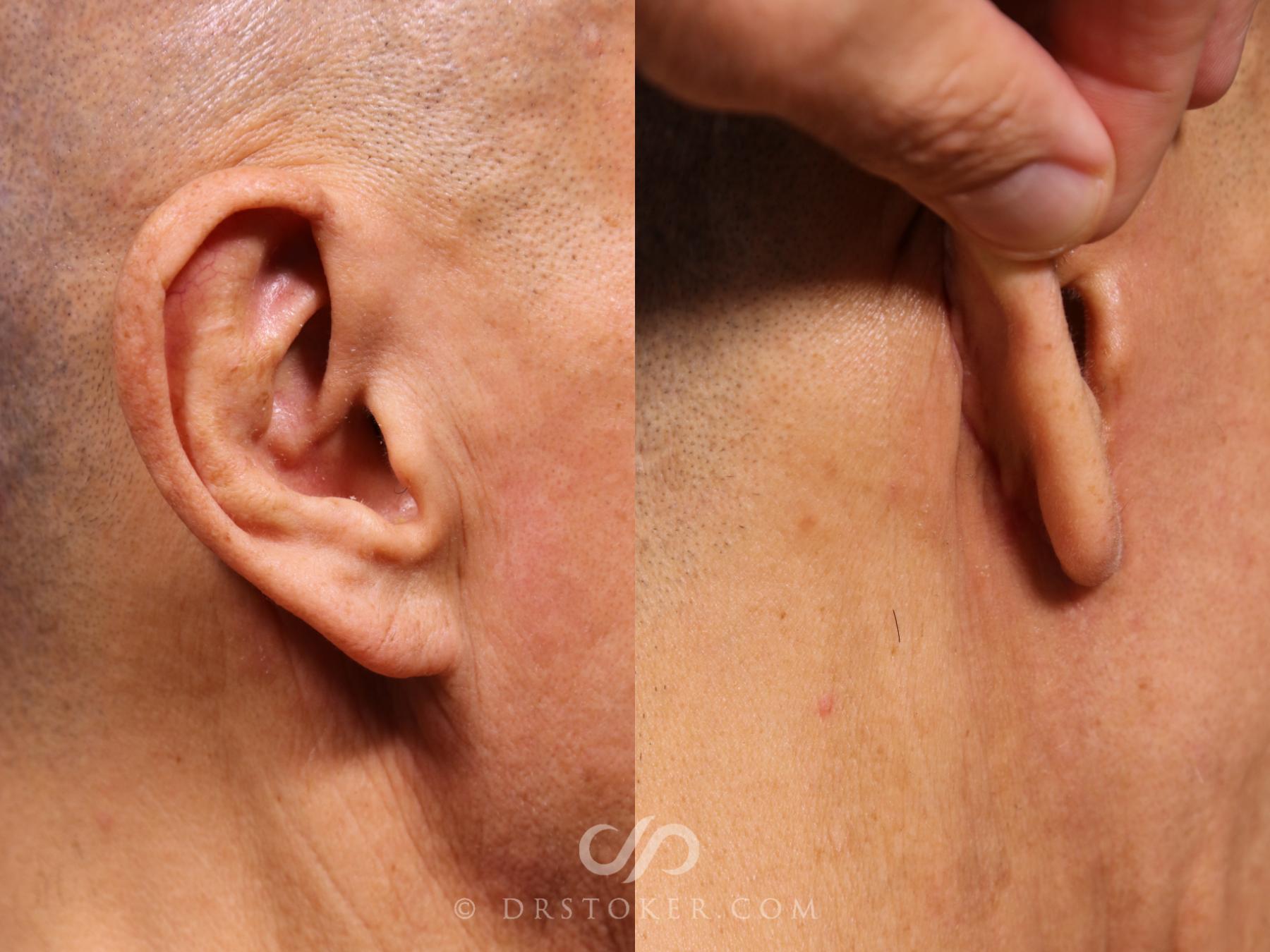Before & After Facelift Incisions (Hidden Scars)  Case 2380 Right Oblique View in Los Angeles, CA