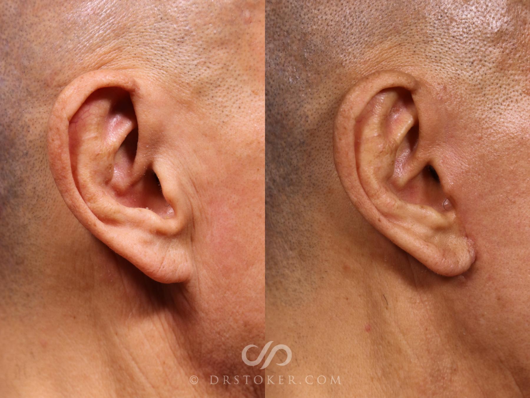 Before & After Facelift Incisions (Hidden Scars)  Case 2380 Right Side View in Los Angeles, CA