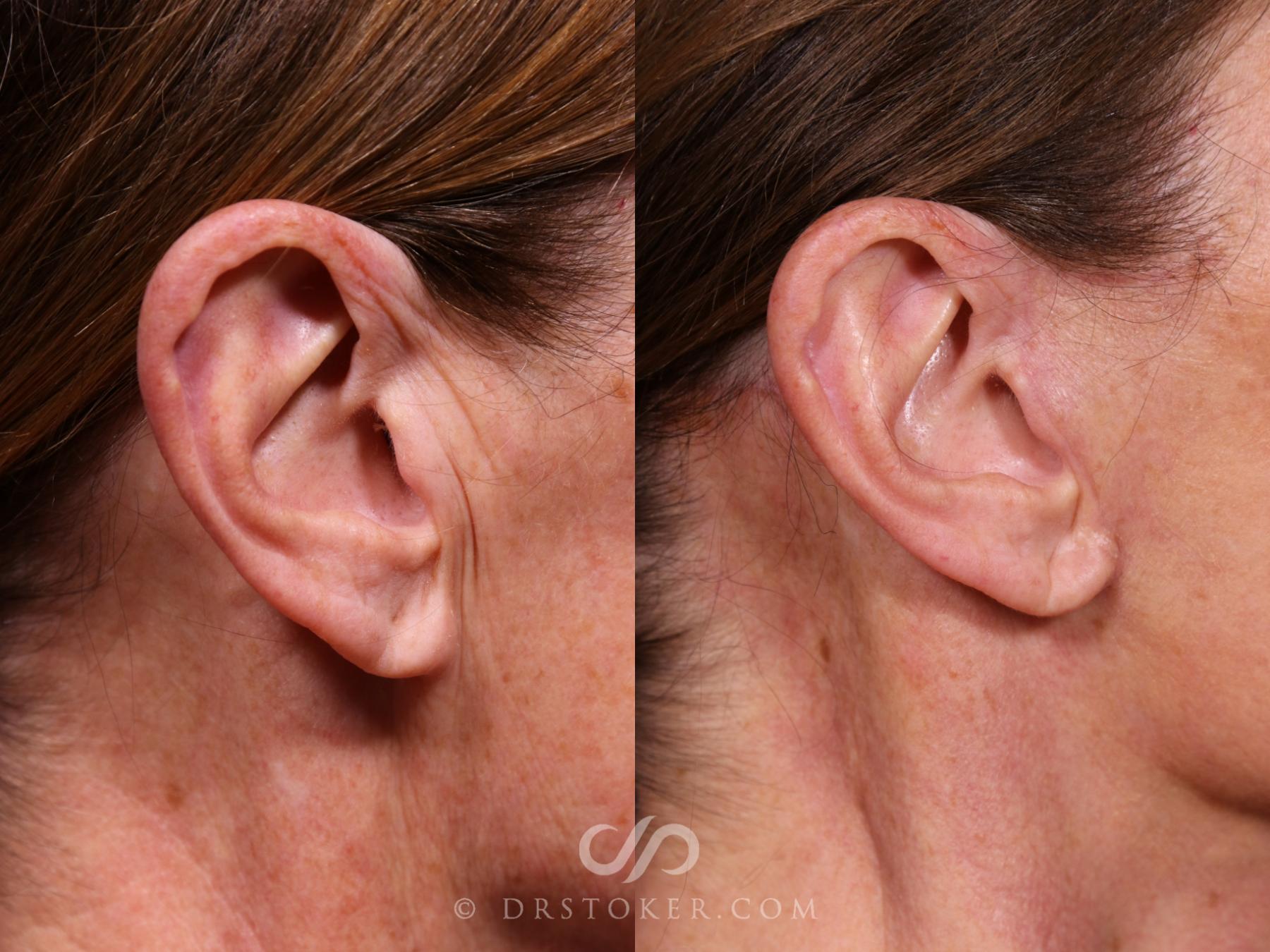 Before & After Facelift Incisions (Hidden Scars)  Case 2652 Right Side View in Los Angeles, CA