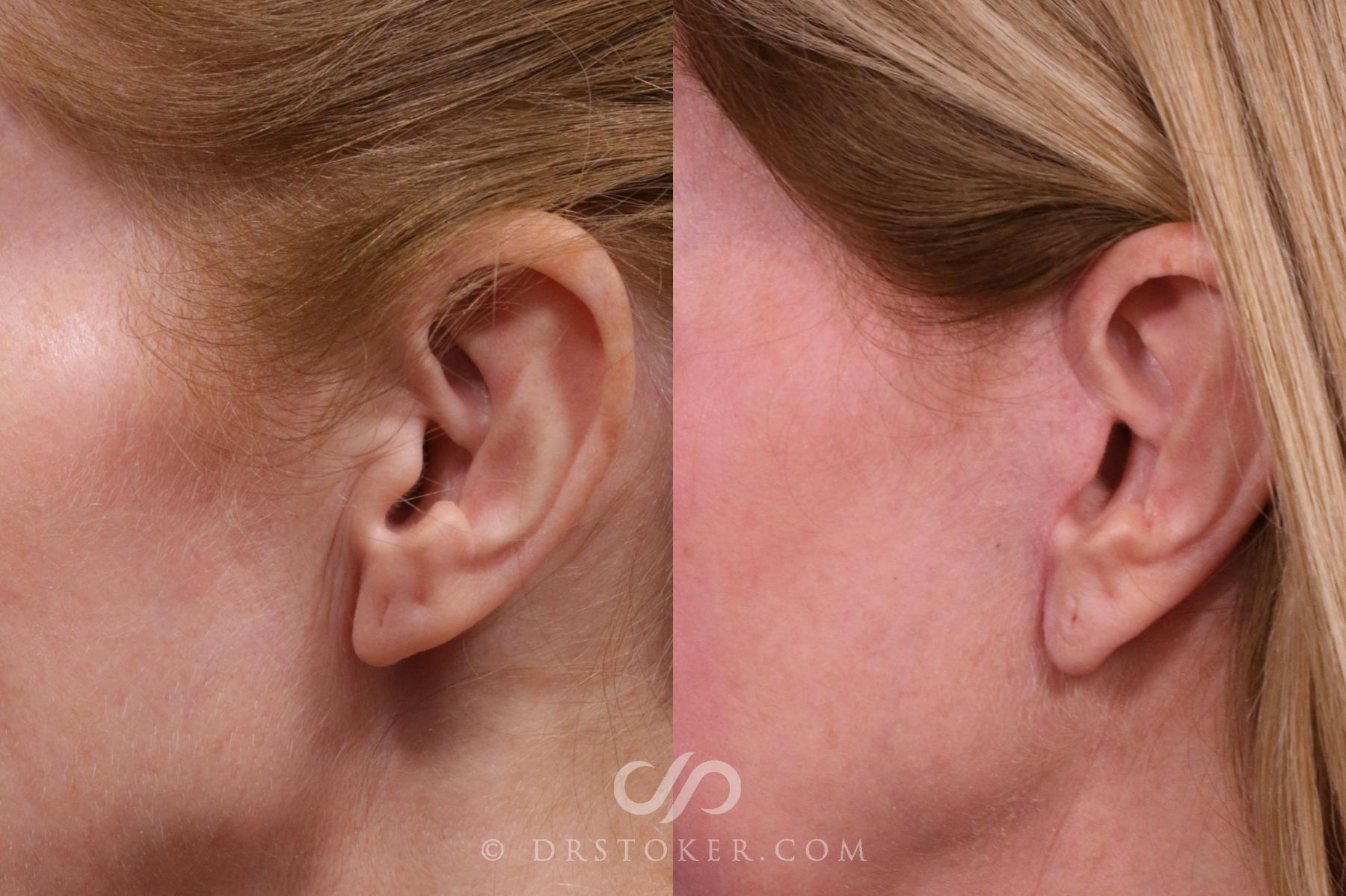 Before & After Facelift Incisions (Hidden Scars)  Case 2658 Left Side View in Los Angeles, CA