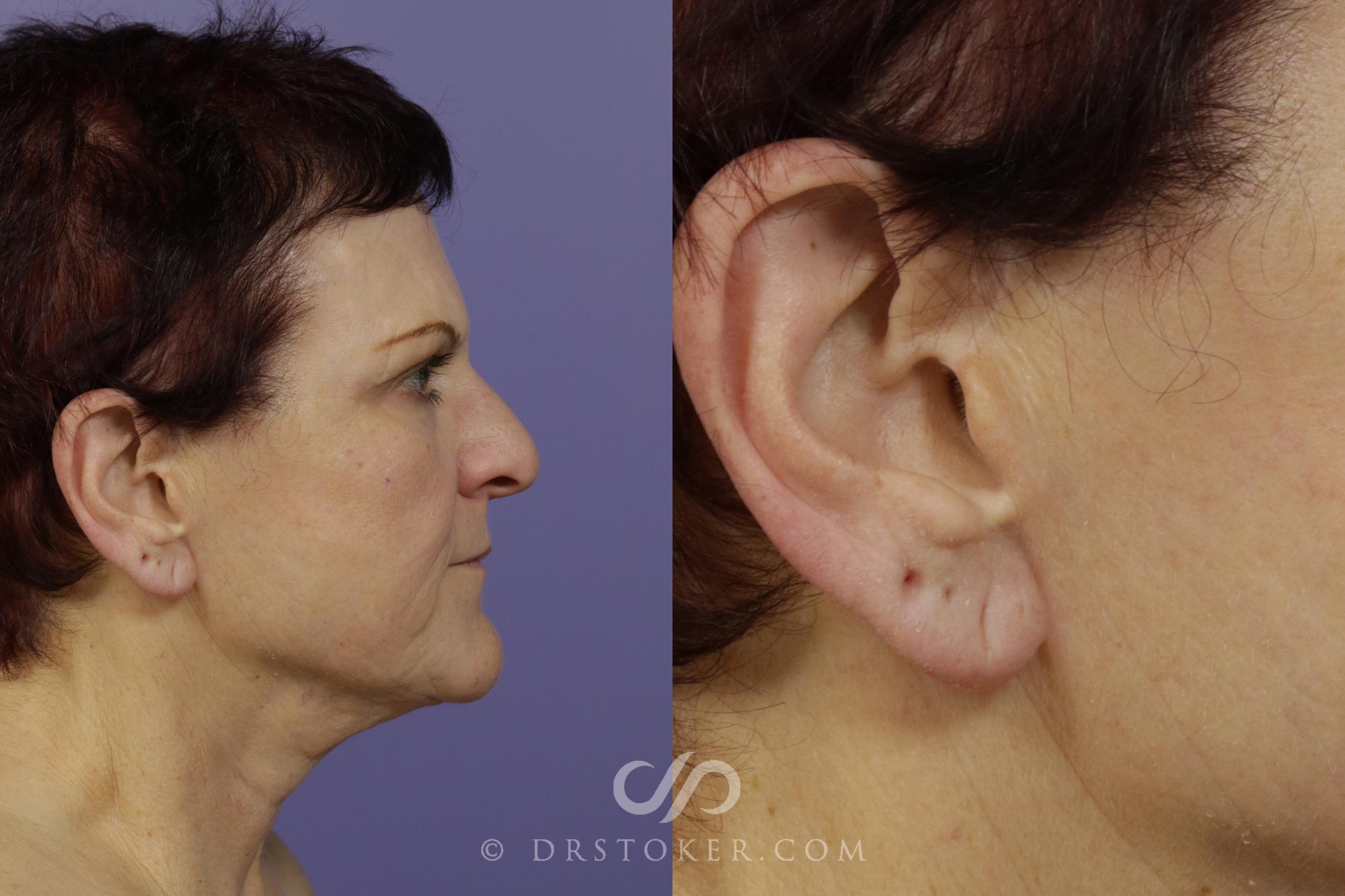 Before & After Facelift Incisions (Hidden Scars) Case 1435 View #1 View in Los Angeles, CA