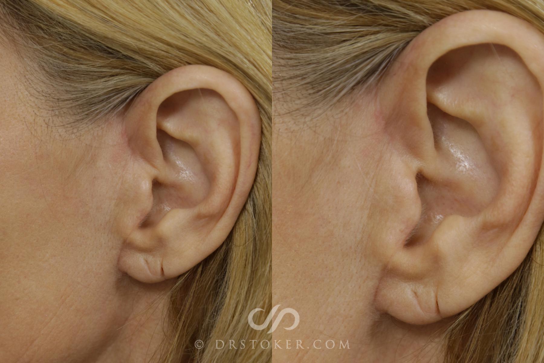 Before & After Facelift Incisions (Hidden Scars)  Case 1432 View #1 View in Los Angeles, CA