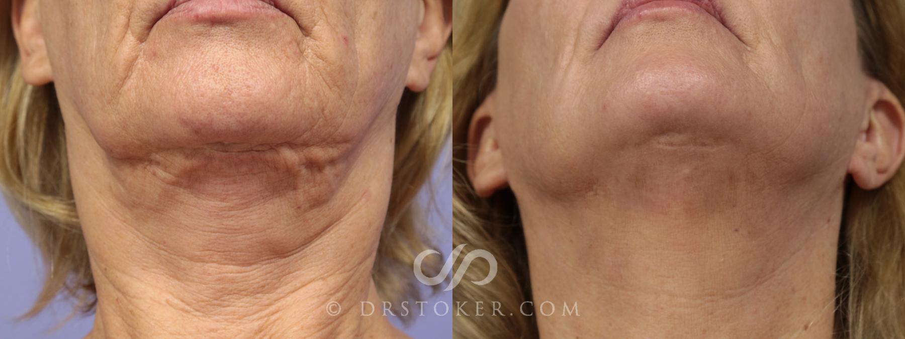 Before & After Facelift Incisions (Hidden Scars)  Case 1433 View #1 View in Los Angeles, CA