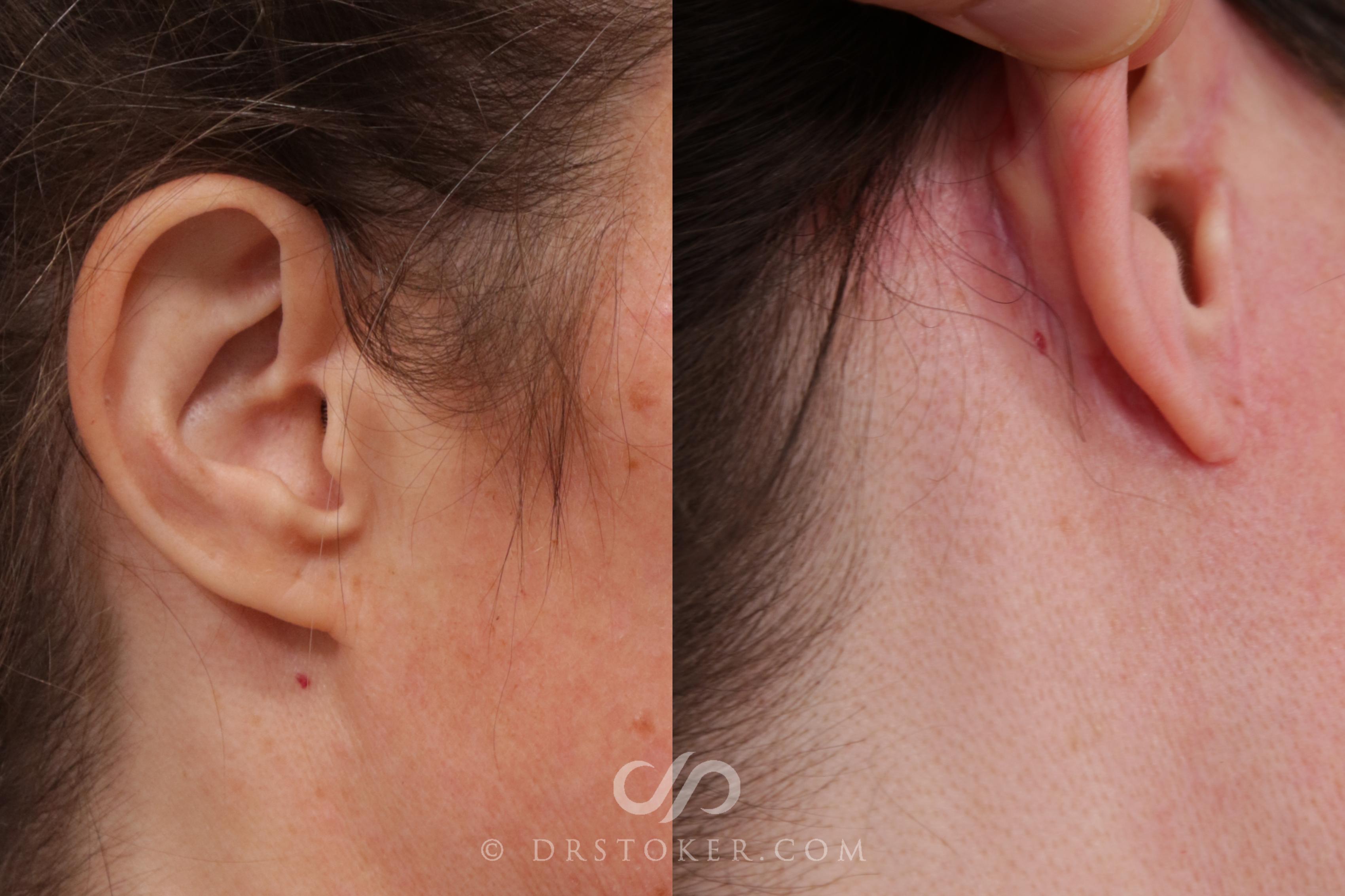 Before & After Facelift Incisions (Hidden Scars)  Case 1842 Right Side View in Los Angeles, CA