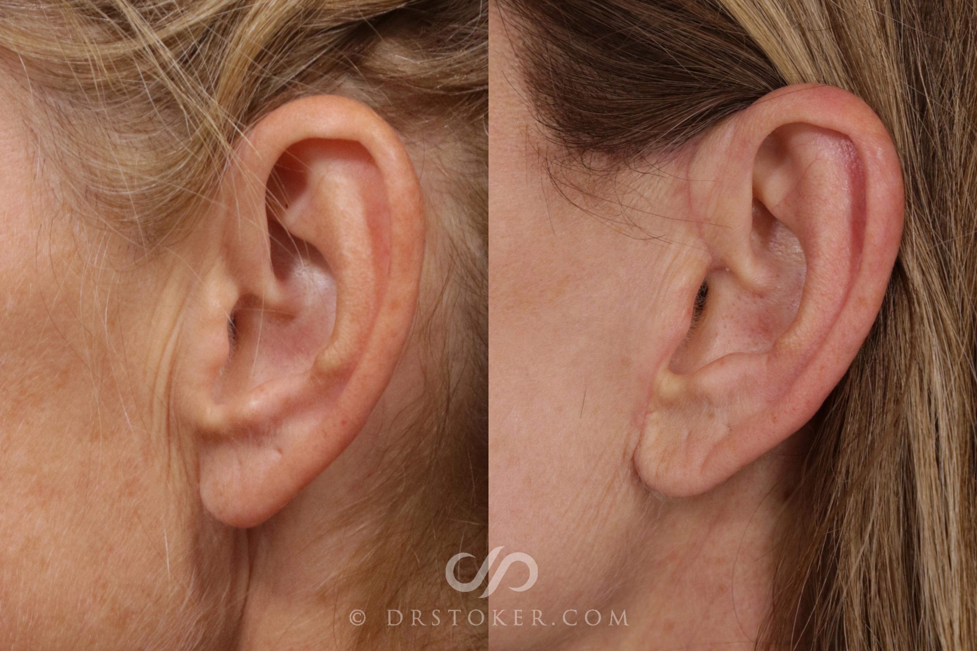 Before & After Facelift Incisions (Hidden Scars)  Case 1843 Left Side View in Los Angeles, CA