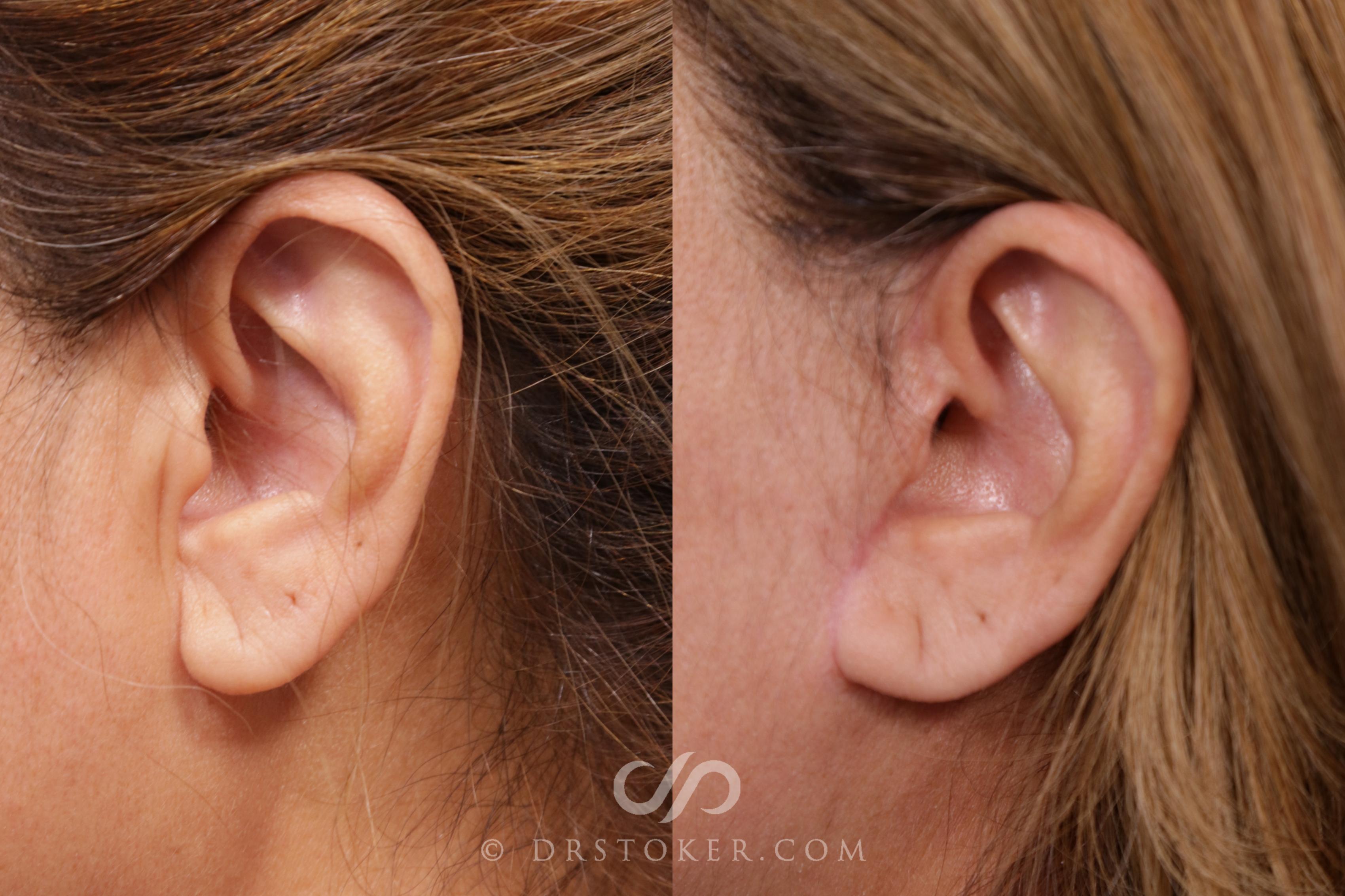 Before & After Facelift Incisions (Hidden Scars)  Case 2034 Left Side View in Los Angeles, CA