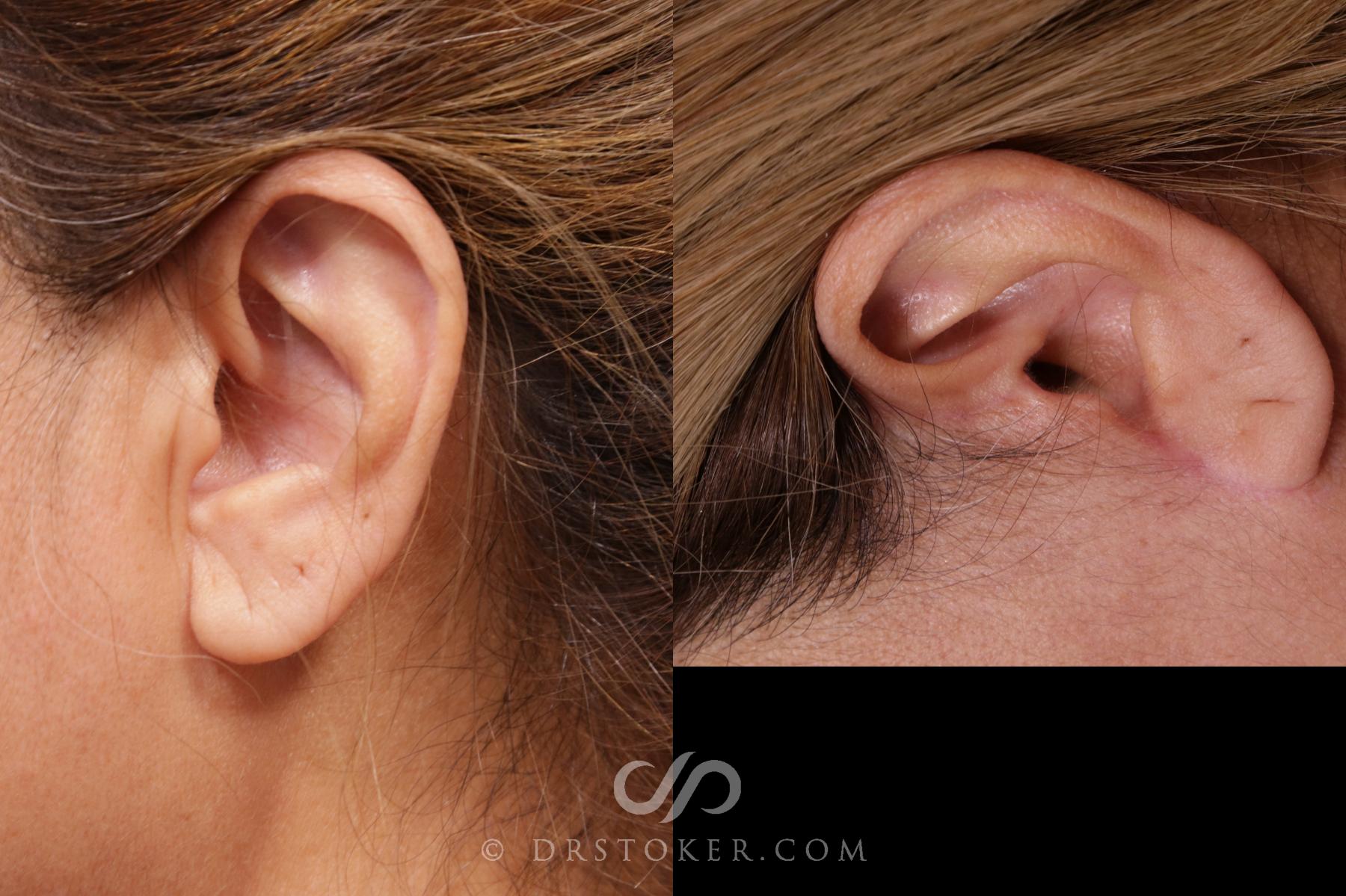 Before & After Facelift Incisions (Hidden Scars)  Case 2120 Left Side View in Los Angeles, CA