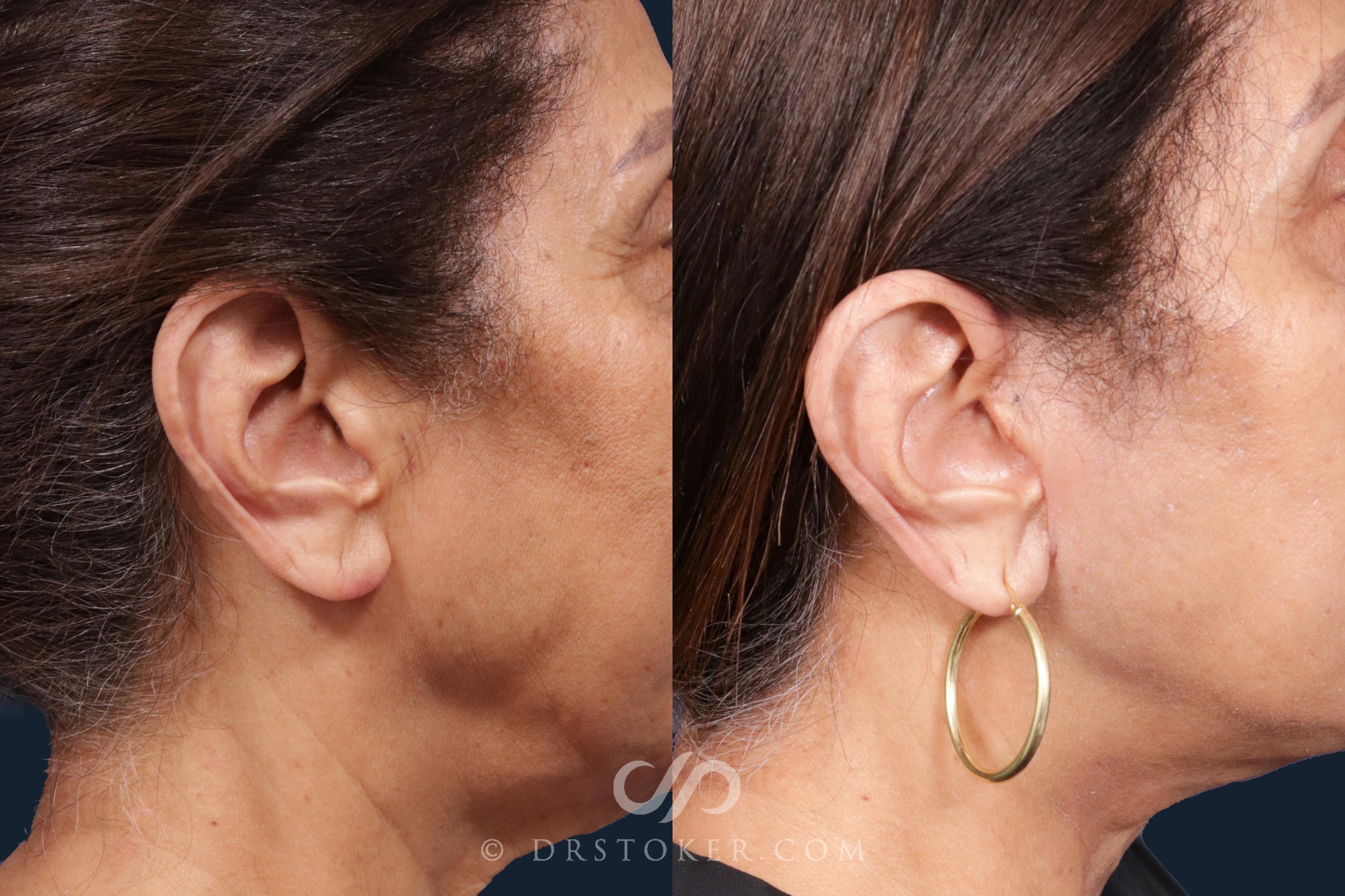Before & After Facelift Incisions (Hidden Scars)  Case 2147 Right Side View in Los Angeles, CA