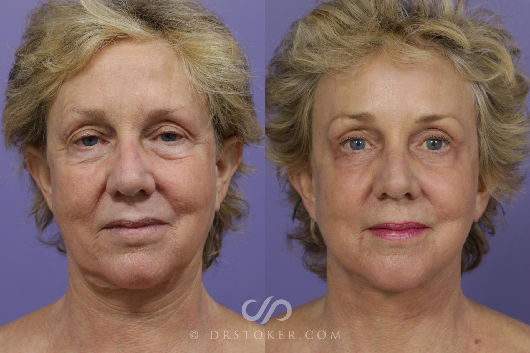 Before & After Neck Lift - Traceless Neck Lift  Case 1298 View #1 View in Los Angeles, CA