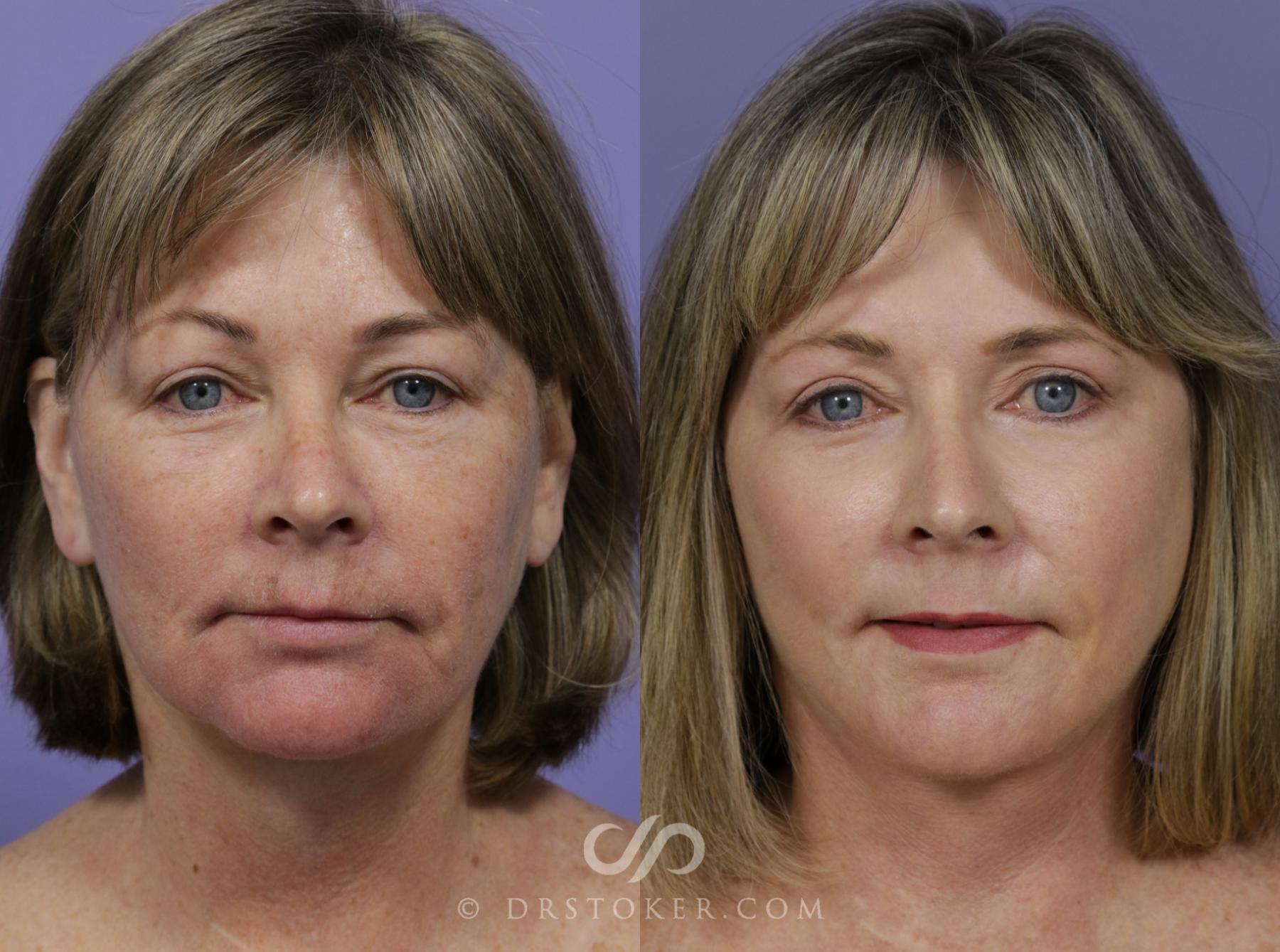 Before & After Laser Skin Resurfacing Case 1300 View #1 View in Los Angeles, CA