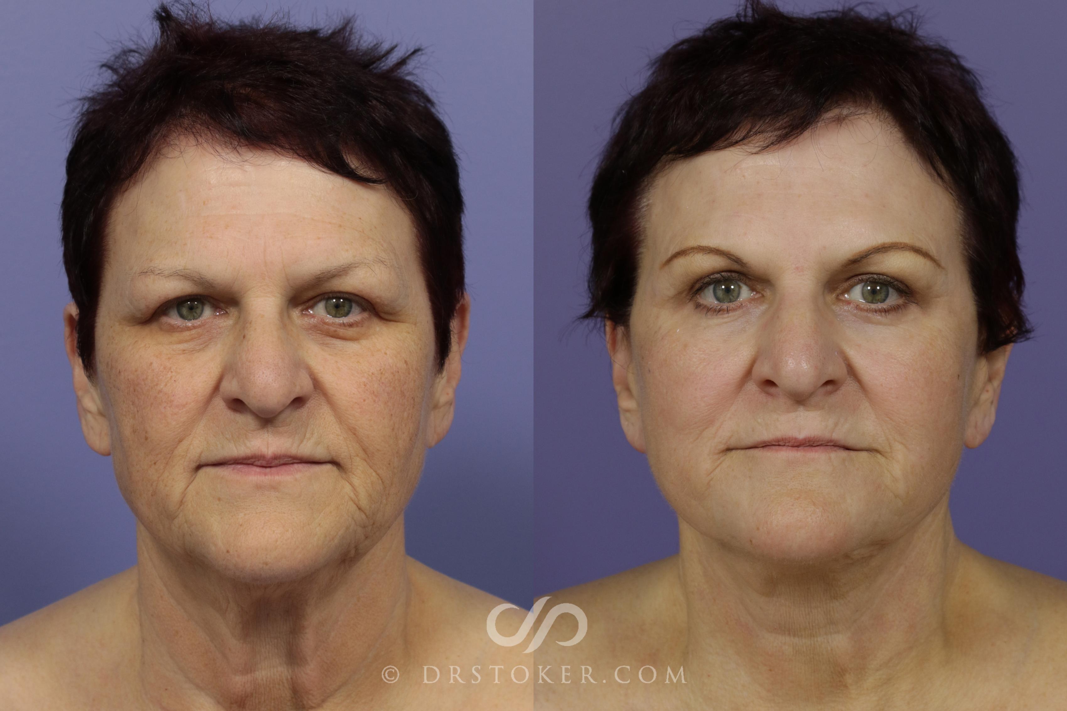 Before & After Laser Skin Resurfacing Case 1426 View #1 View in Los Angeles, CA