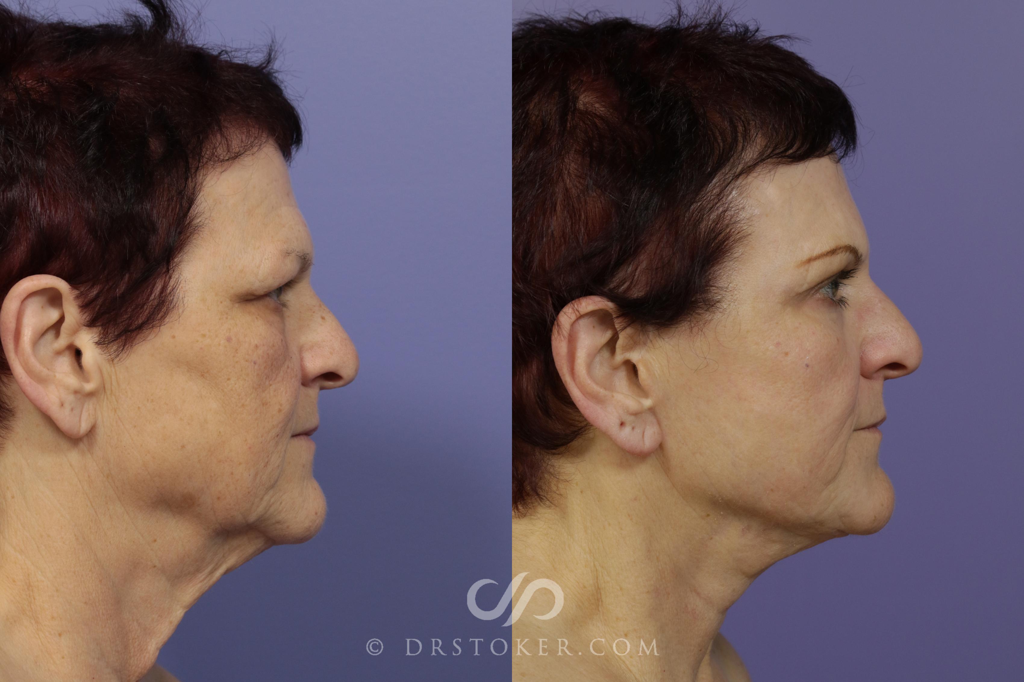 Before & After Facelift - Traceless Facelift Case 1426 View #2 View in Los Angeles, CA