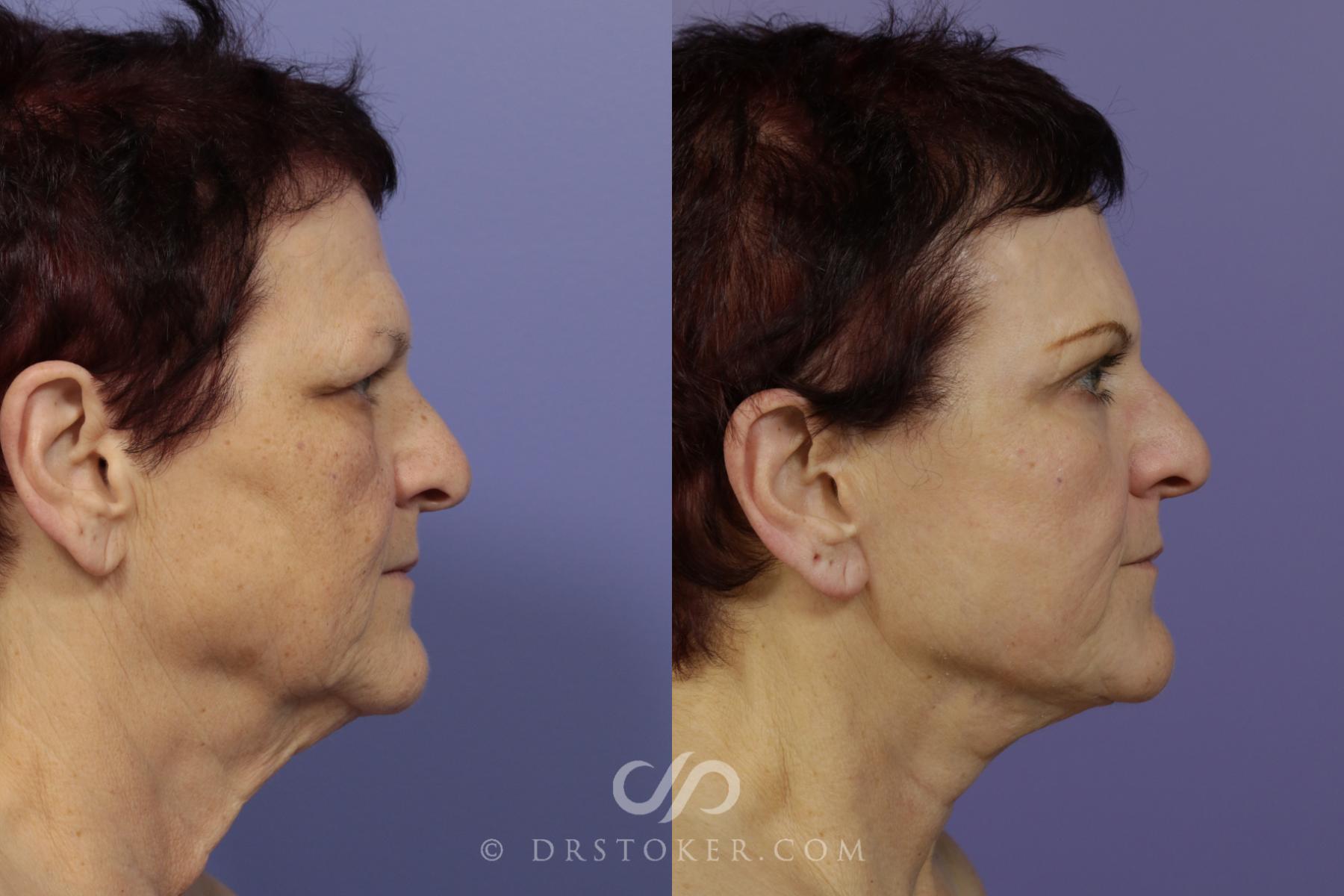Before & After Laser Skin Resurfacing Case 1426 View #2 View in Los Angeles, CA